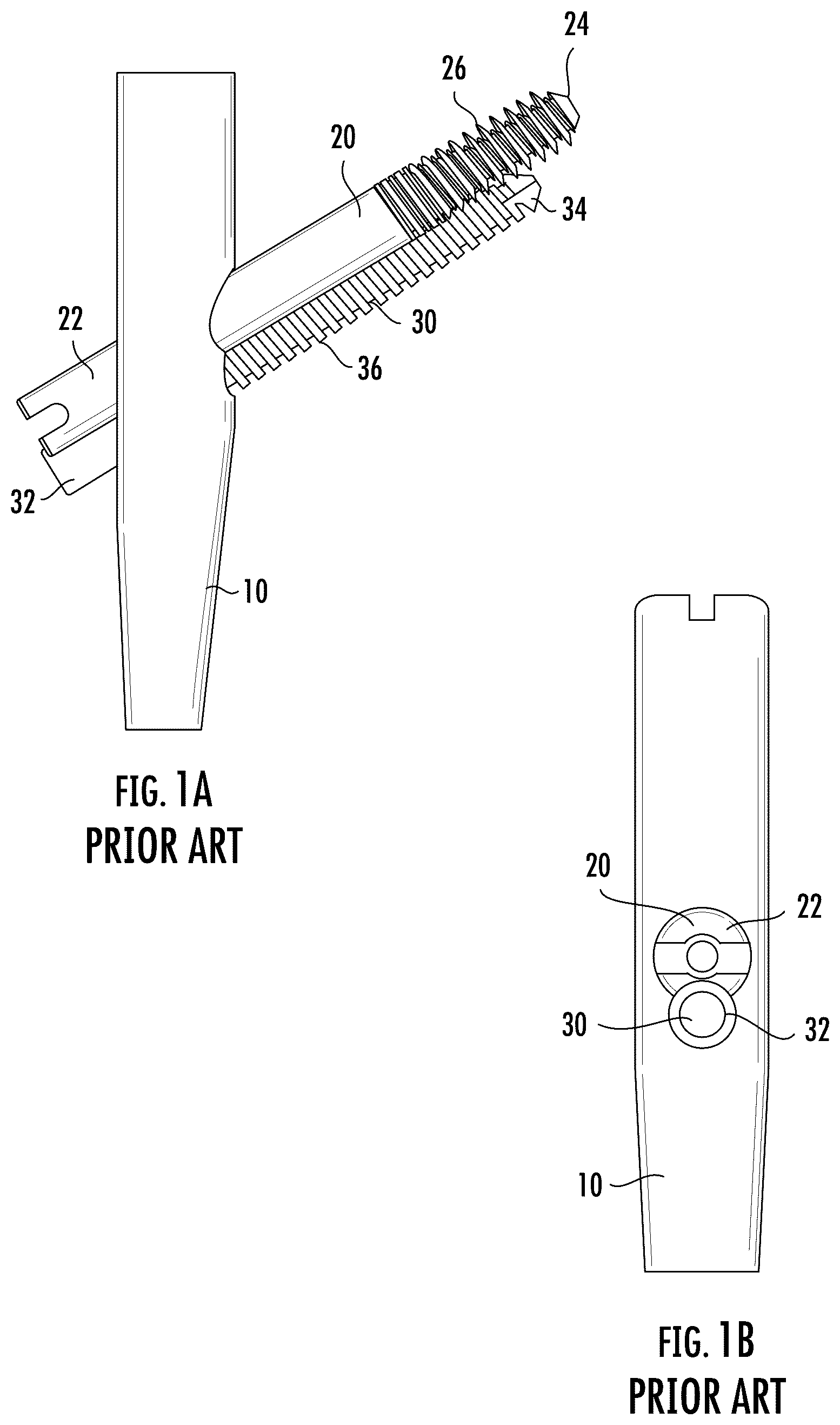 Patent US12551249 Figure 1 – Surgical technique for minimizing medialization of an orthopedic intramedullary nail