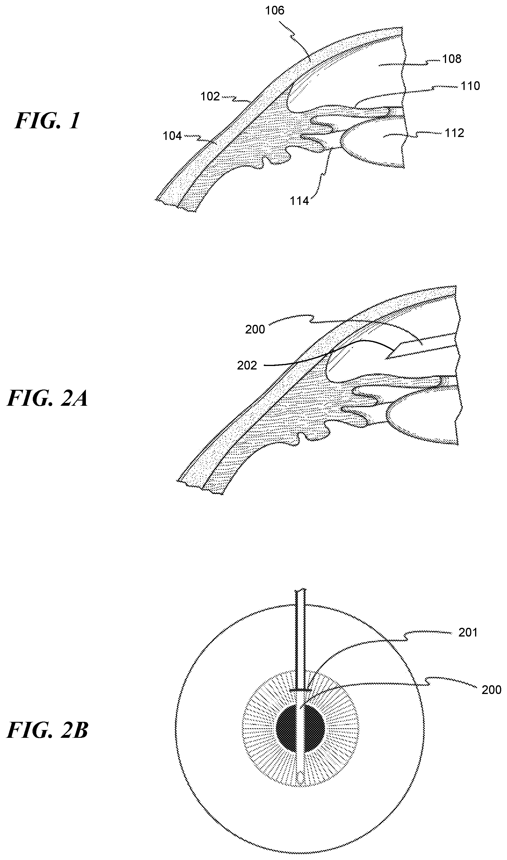Patent US12551268 — Minimally invasive bleb formation devices and methods for using such devices — Figure 1