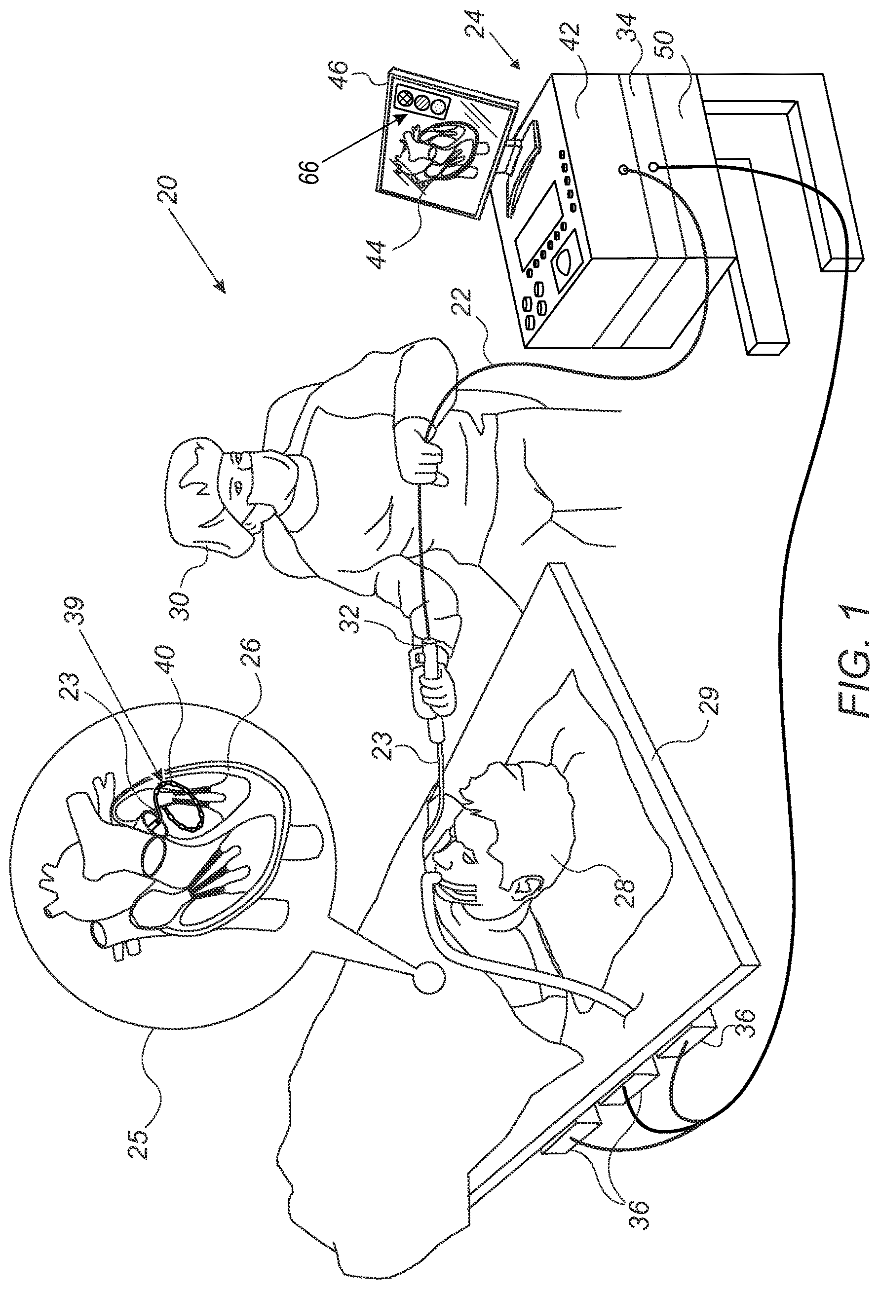 Patent US12551269 Figure 1 – Displaying indications of mutual distances among electrodes of a flexible ablation catheter