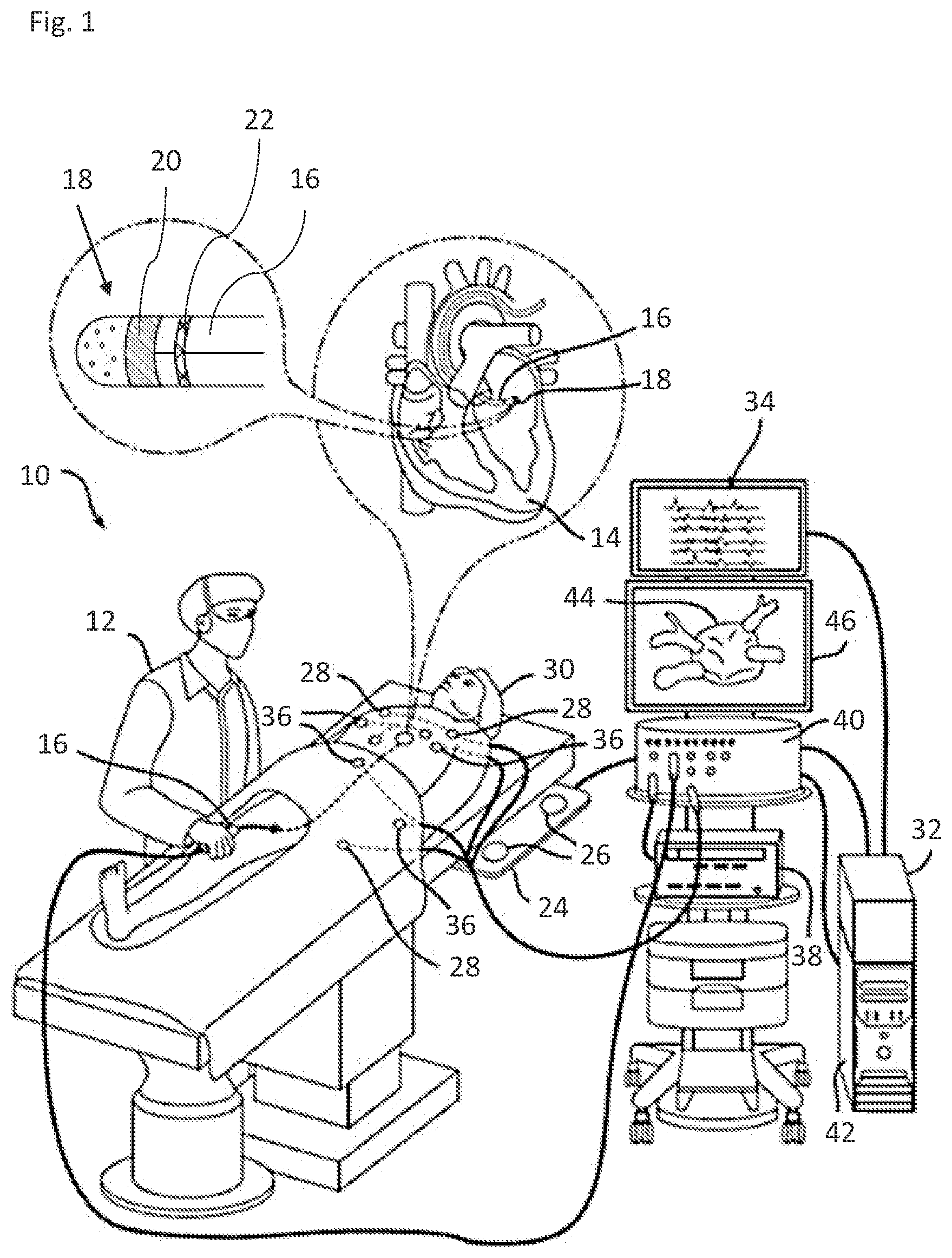 Patent US12551272 — Precise irrigation rate for ablation catheter — Figure 1
