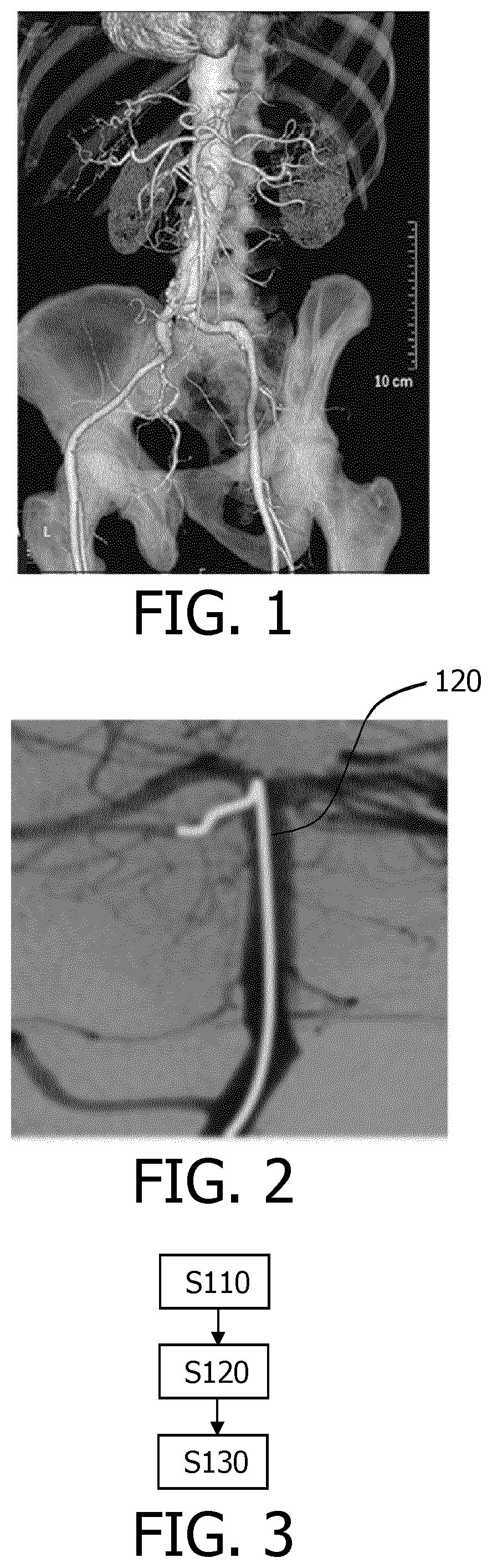 Patent US12551293 Figure 1 – Navigating an interventional device