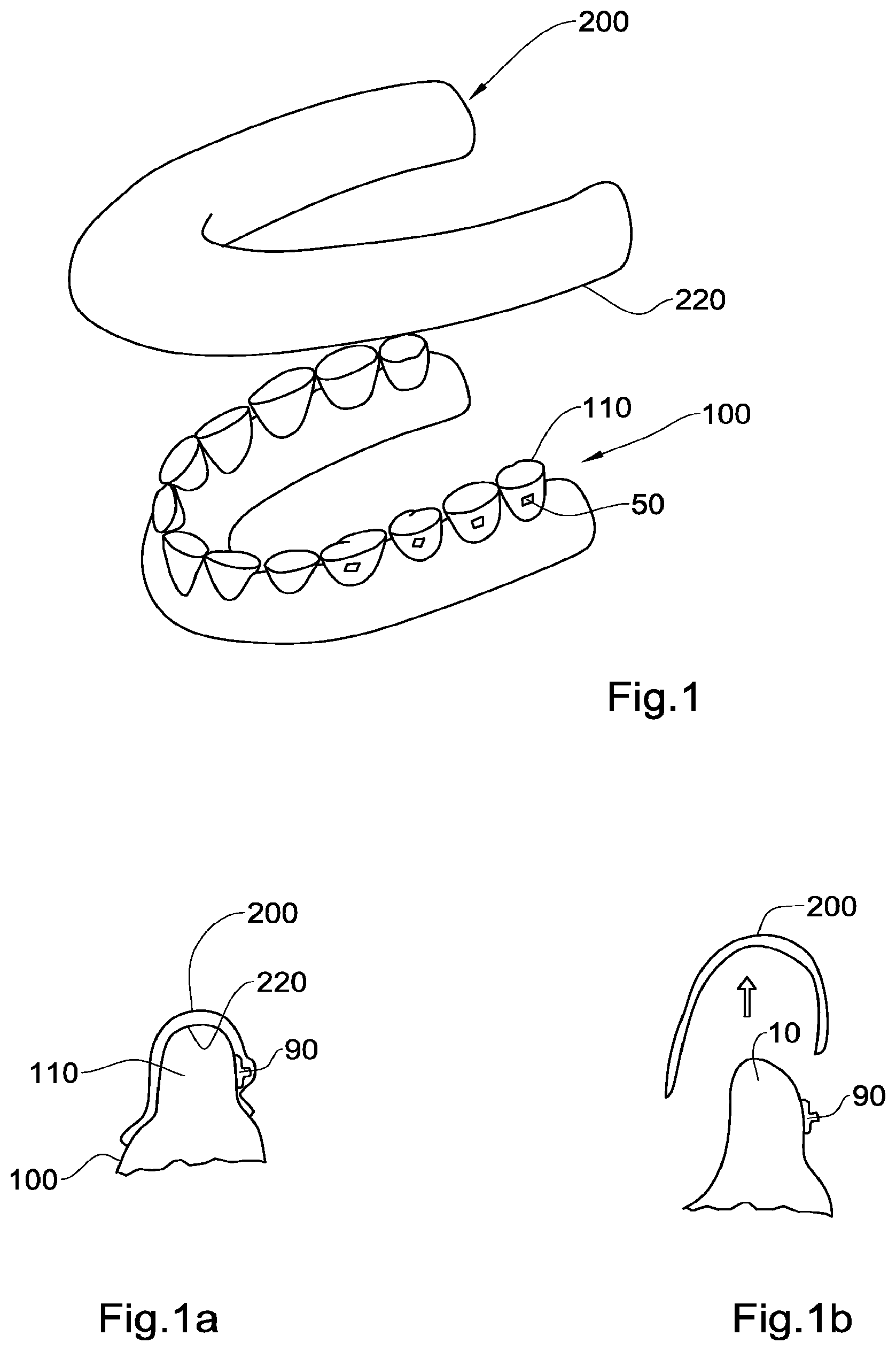 Patent US12551318 Figure 1 – Method, system and model for indirect bonding