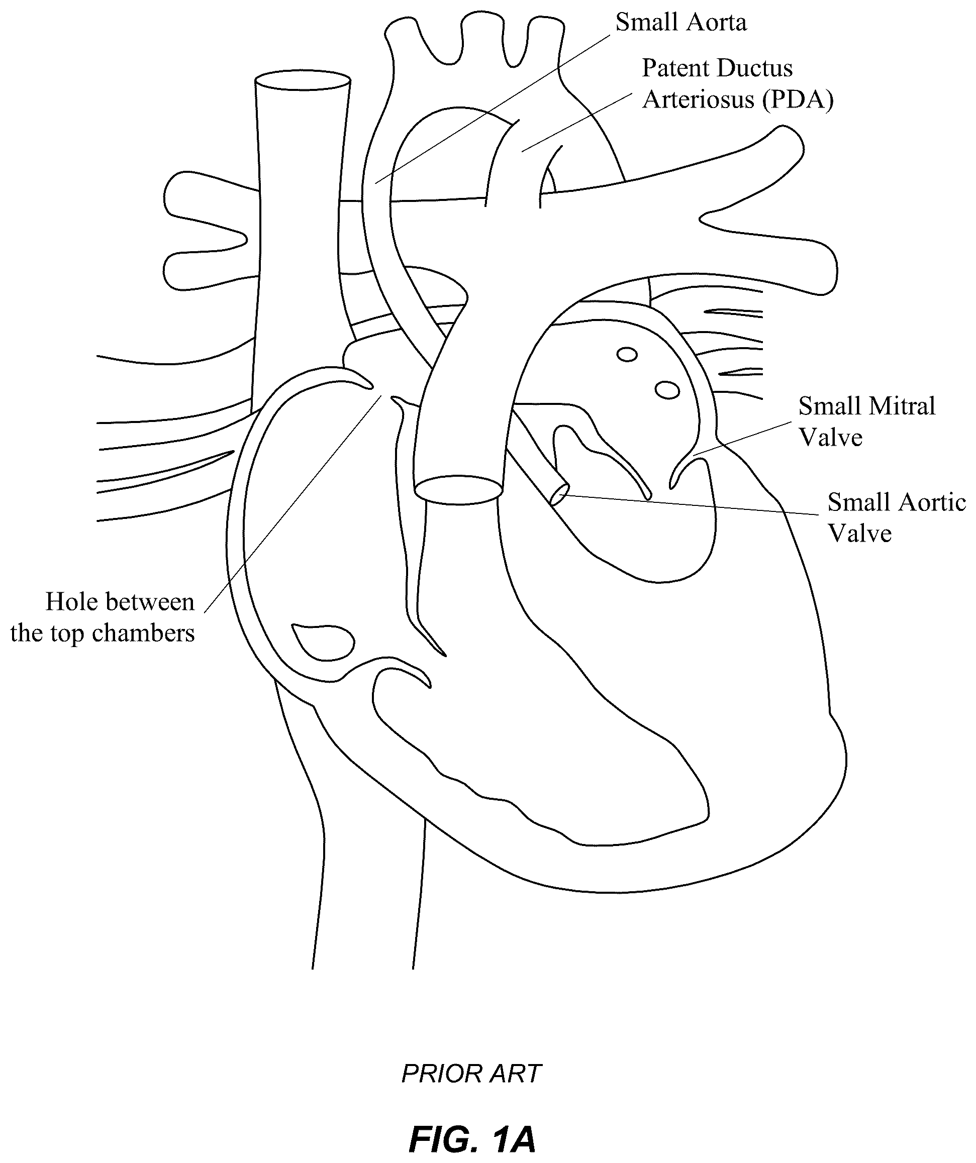Patent US12551329 — Transcatheter growth devices and methods for Norwood, Glenn and Fontan therapy — Figure 1