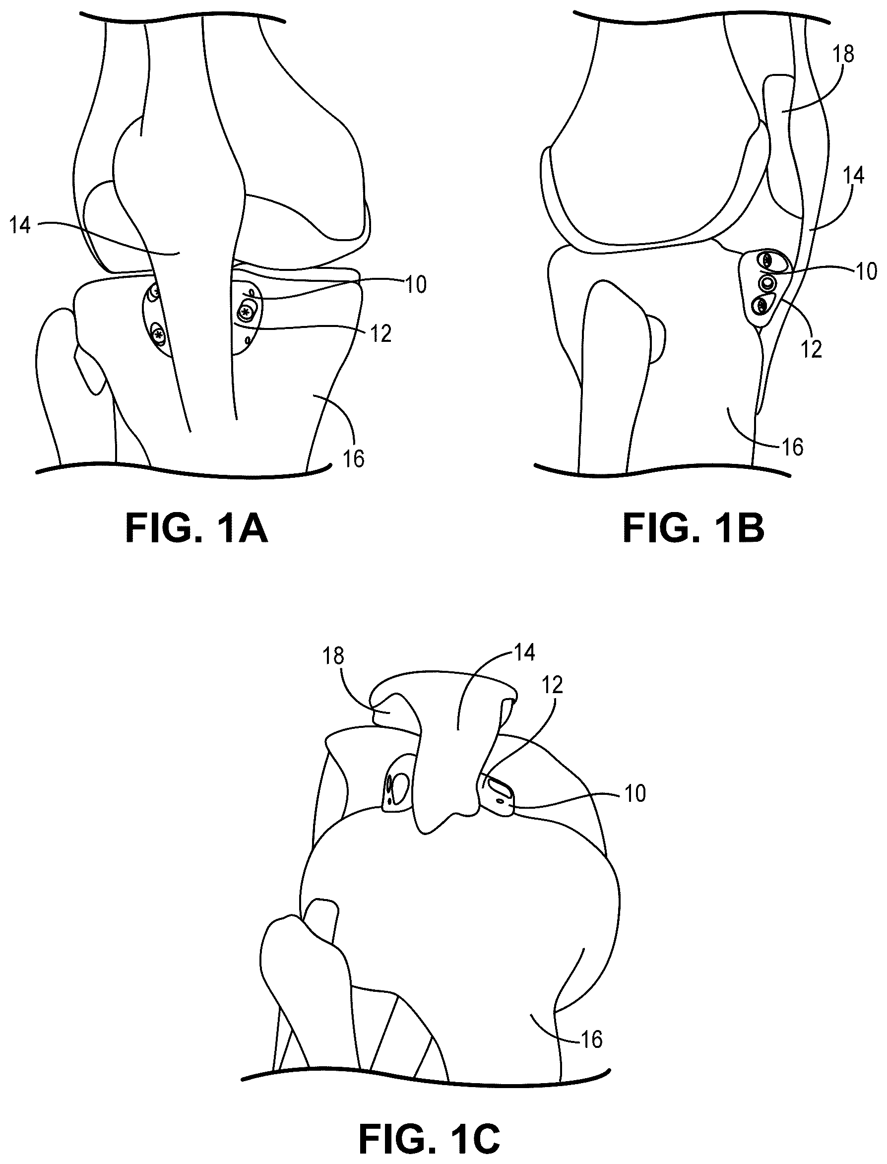Patent US12551330 — Multiplanar tendon realignment implants and related systems and methods — Figure 1