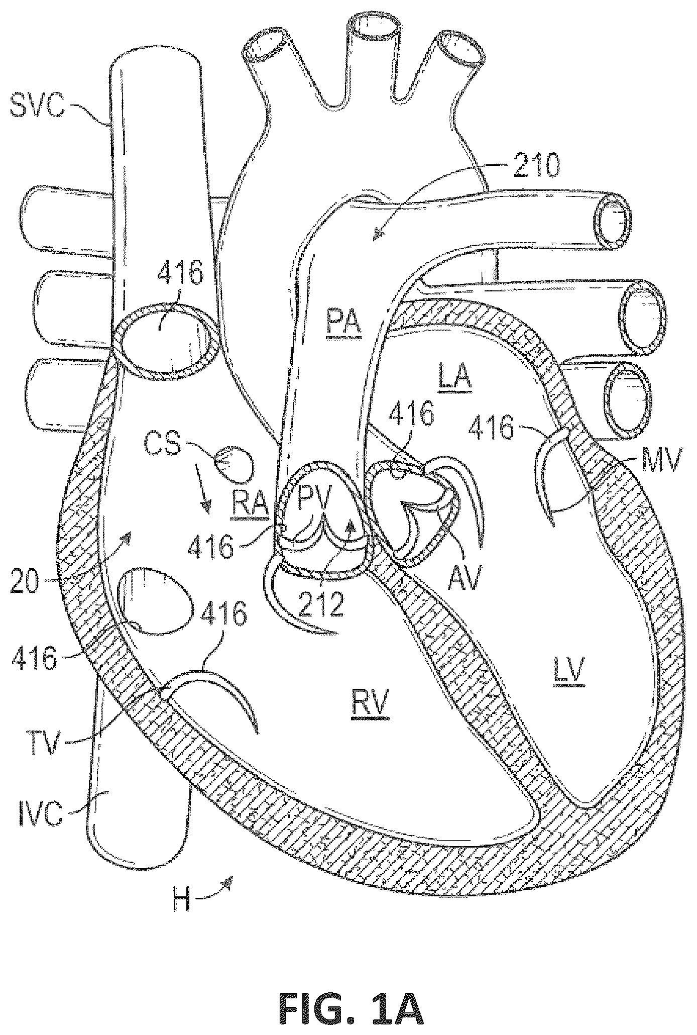 Patent US12551338 — Transcatheter pulmonic regenerative valve — Figure 1