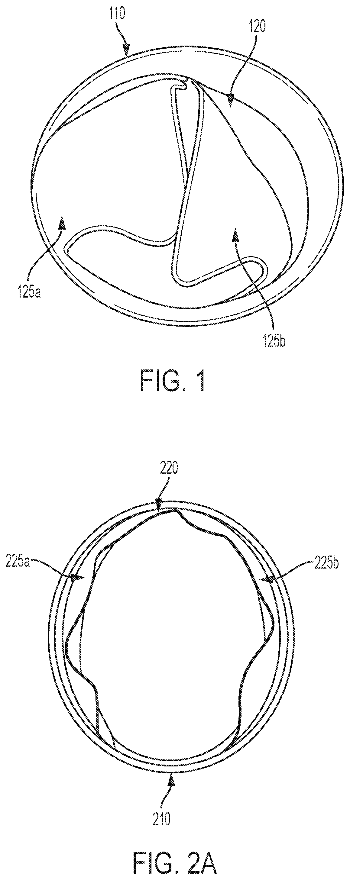 Patent US12551339 — Expandable implantable conduit — Figure 1