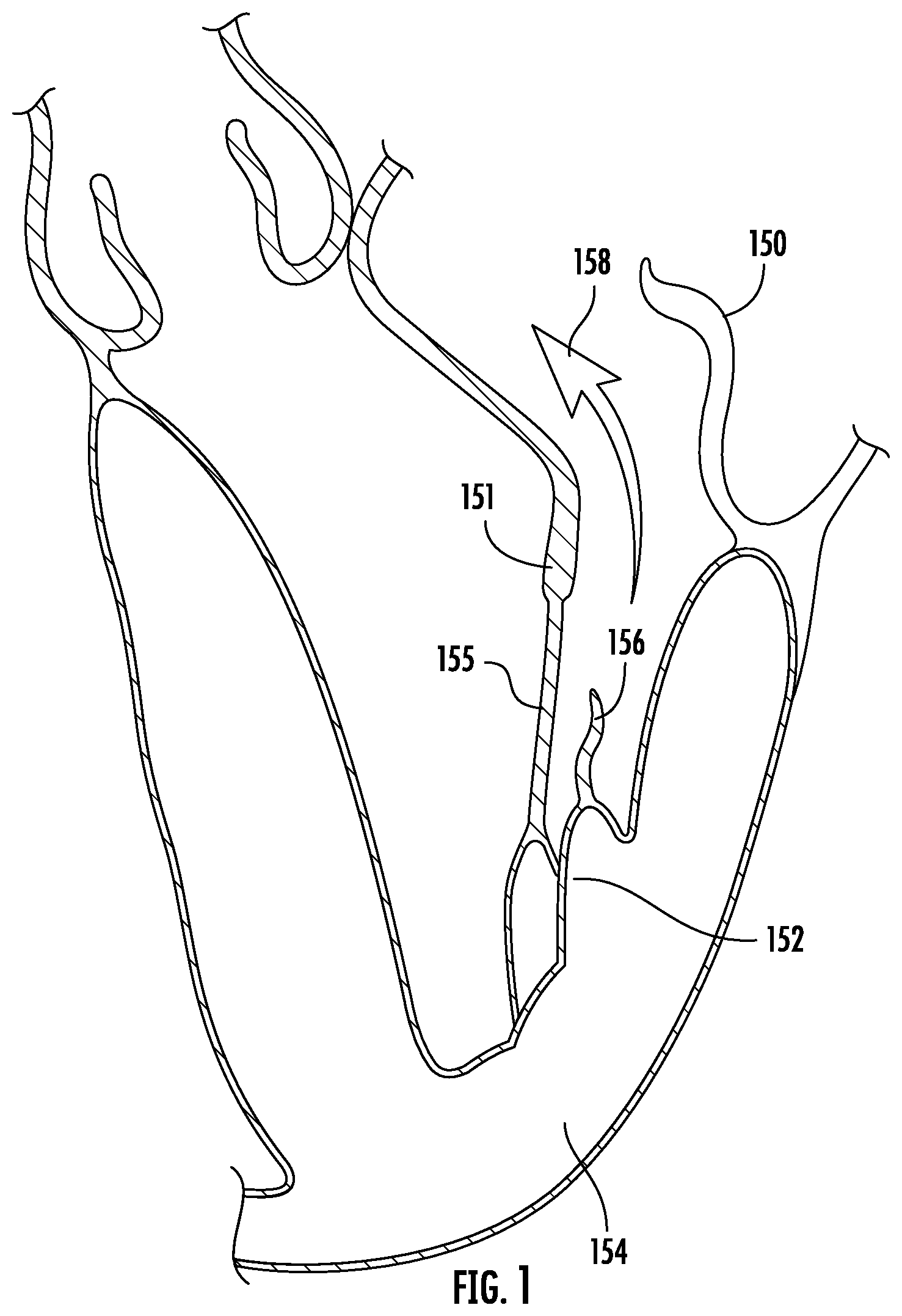 Patent US12551342 — Devices, systems, and methods for adjustably tensioning an artificial chordae tendineae between a leaflet and a papillary muscle or heart wall — Figure 1