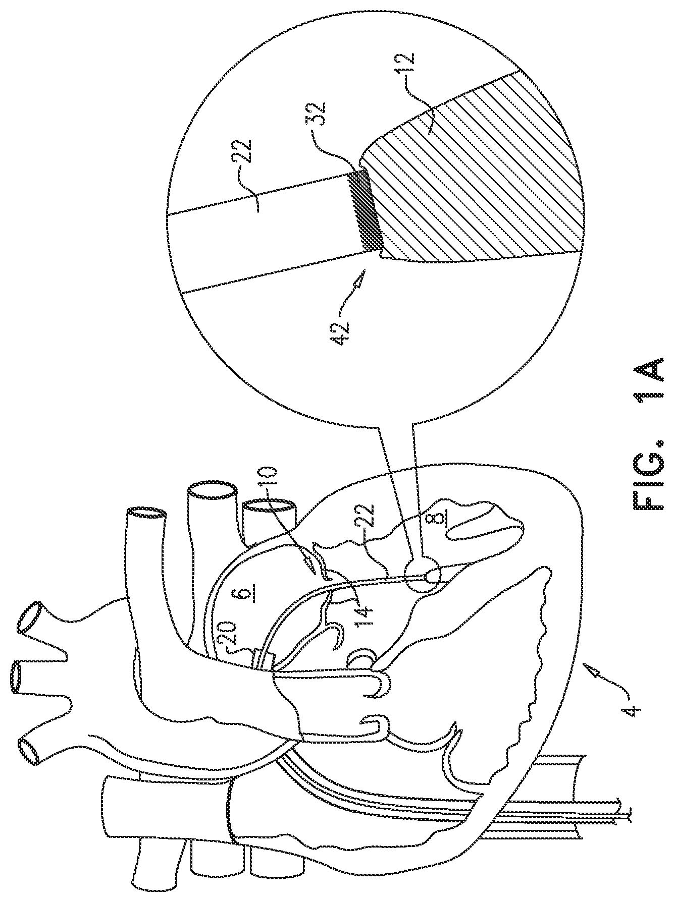 Patent US12551343 Figure 1 – Techniques for fluoroscopic cardiac measurement