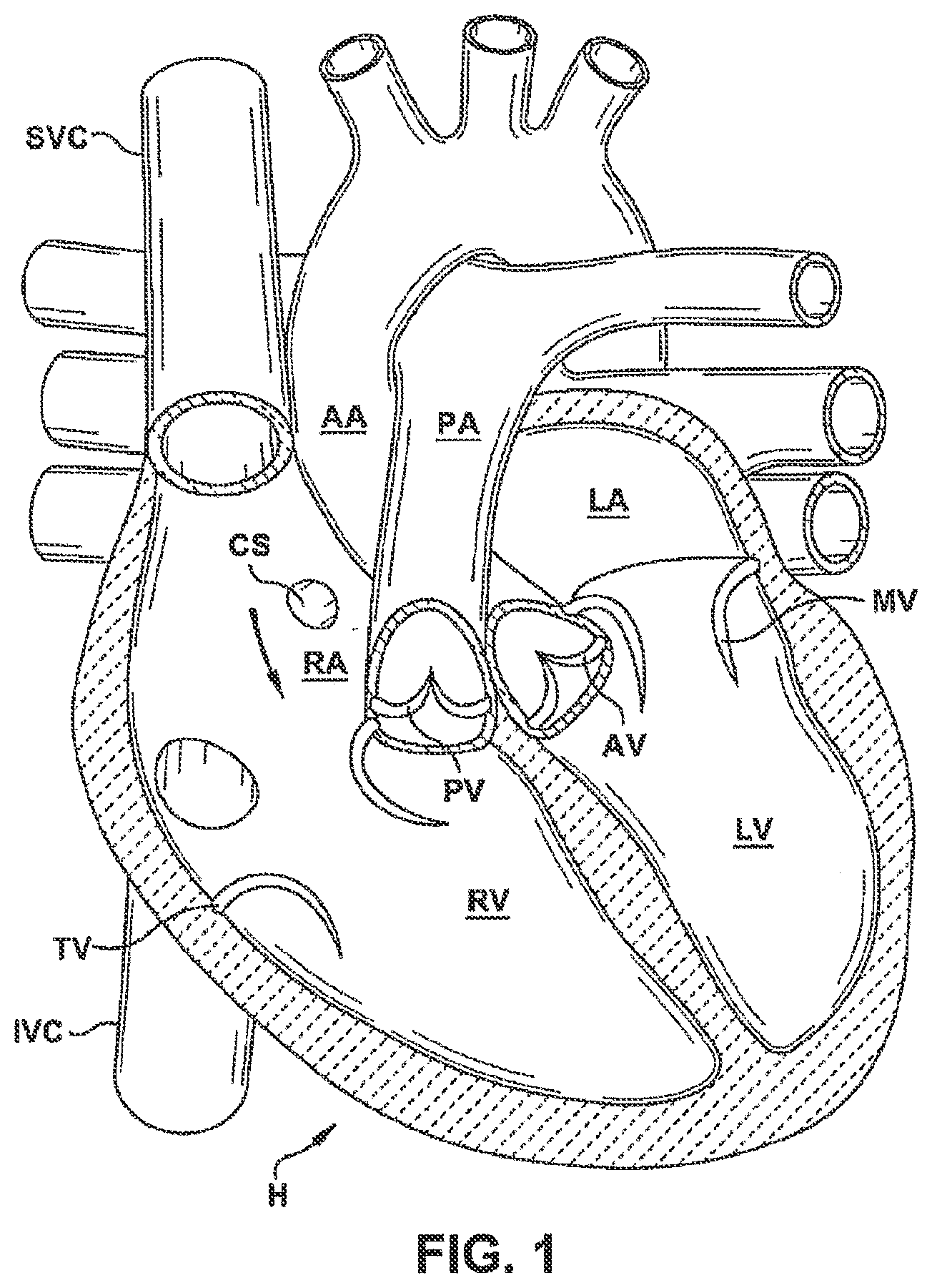 Patent US12551344 Figure 1 – Heart valve sealing devices and delivery devices therefor