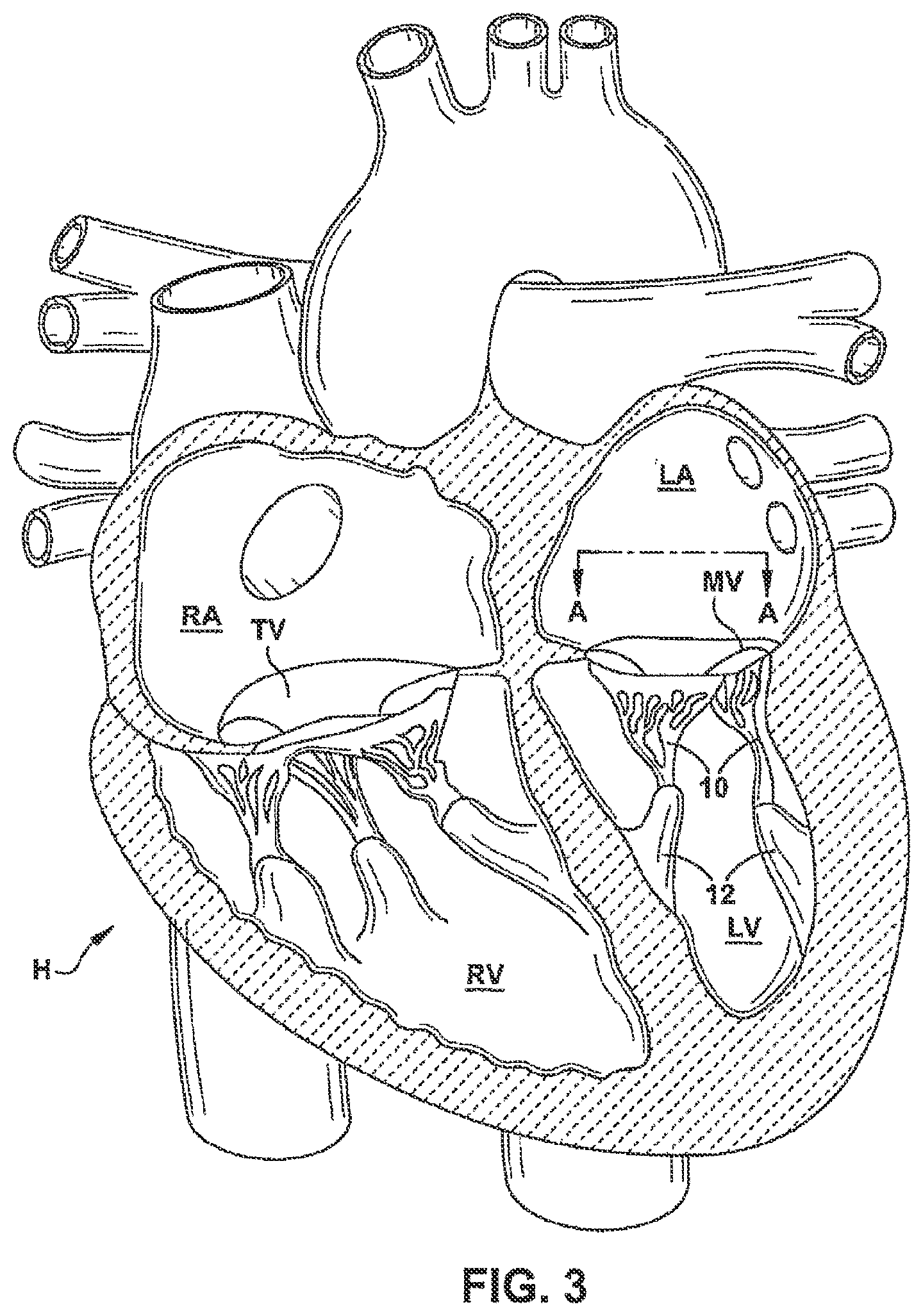 Patent US12551344 Figure 5 – Heart valve sealing devices and delivery devices therefor