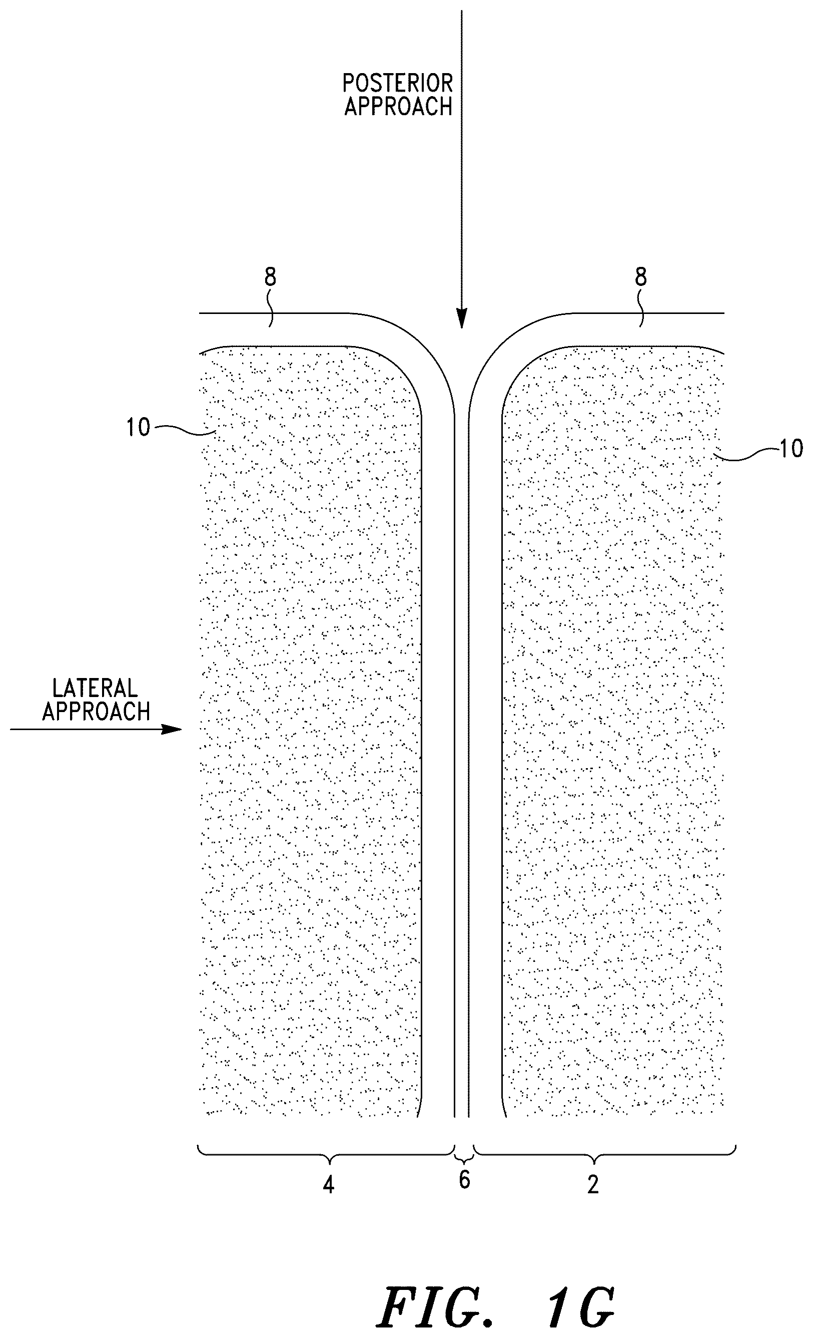 Patent US12551348 Figure 6 – Systems for sacroiliac joint stabilization