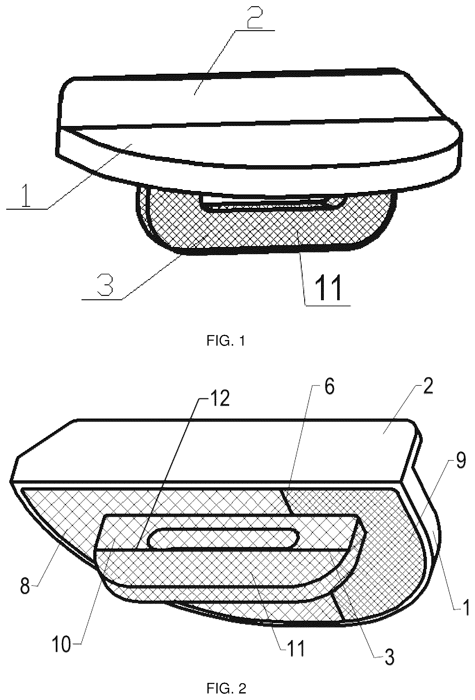 Patent US12551350 Figure 1 – Zonal trabecular uni-compartmental tibial plateau containing zirconium-niobium alloy on oxidation layer and preparation method thereof