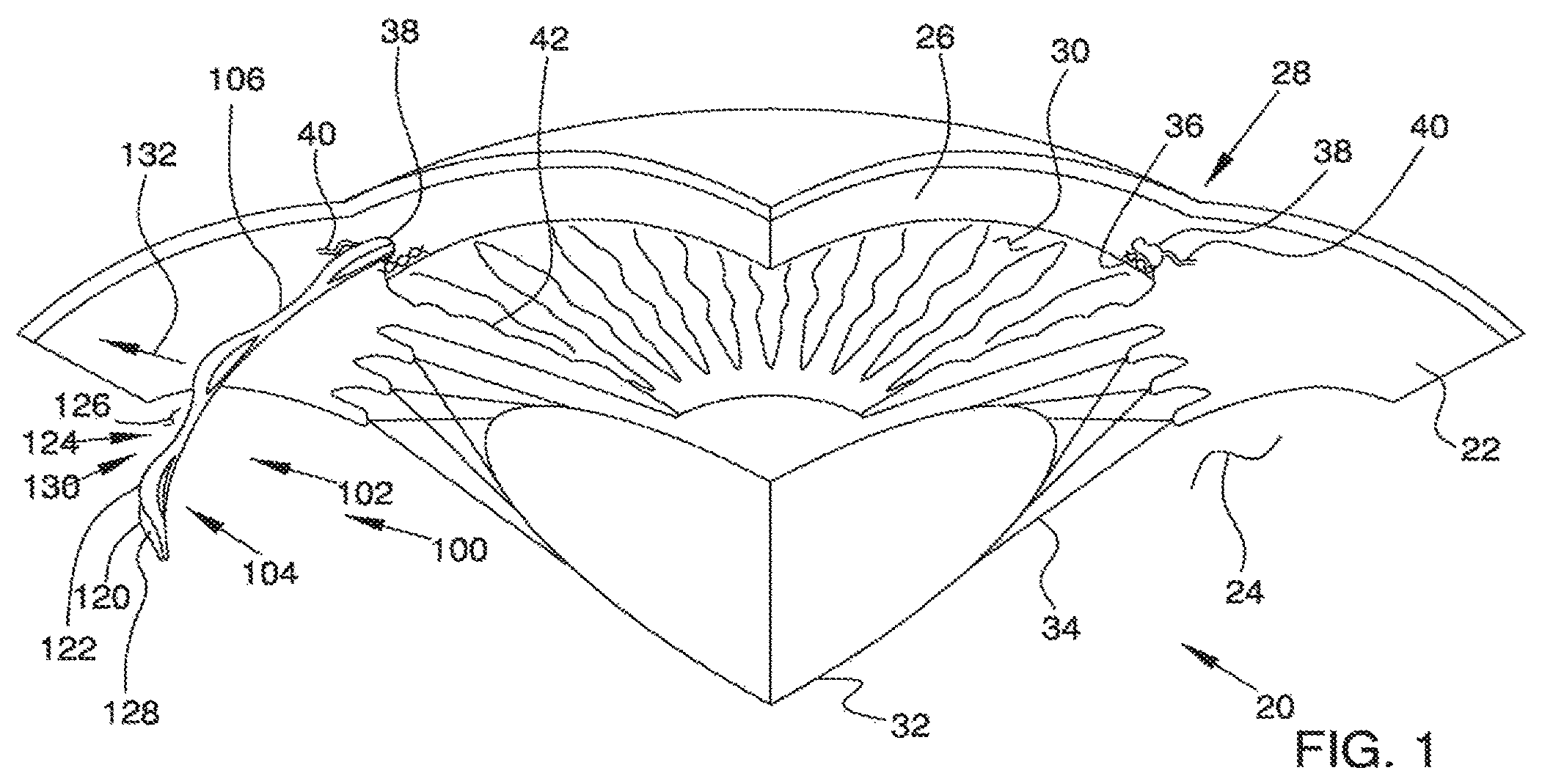 Patent US12551371 Figure 1 – Ocular implant and delivery system