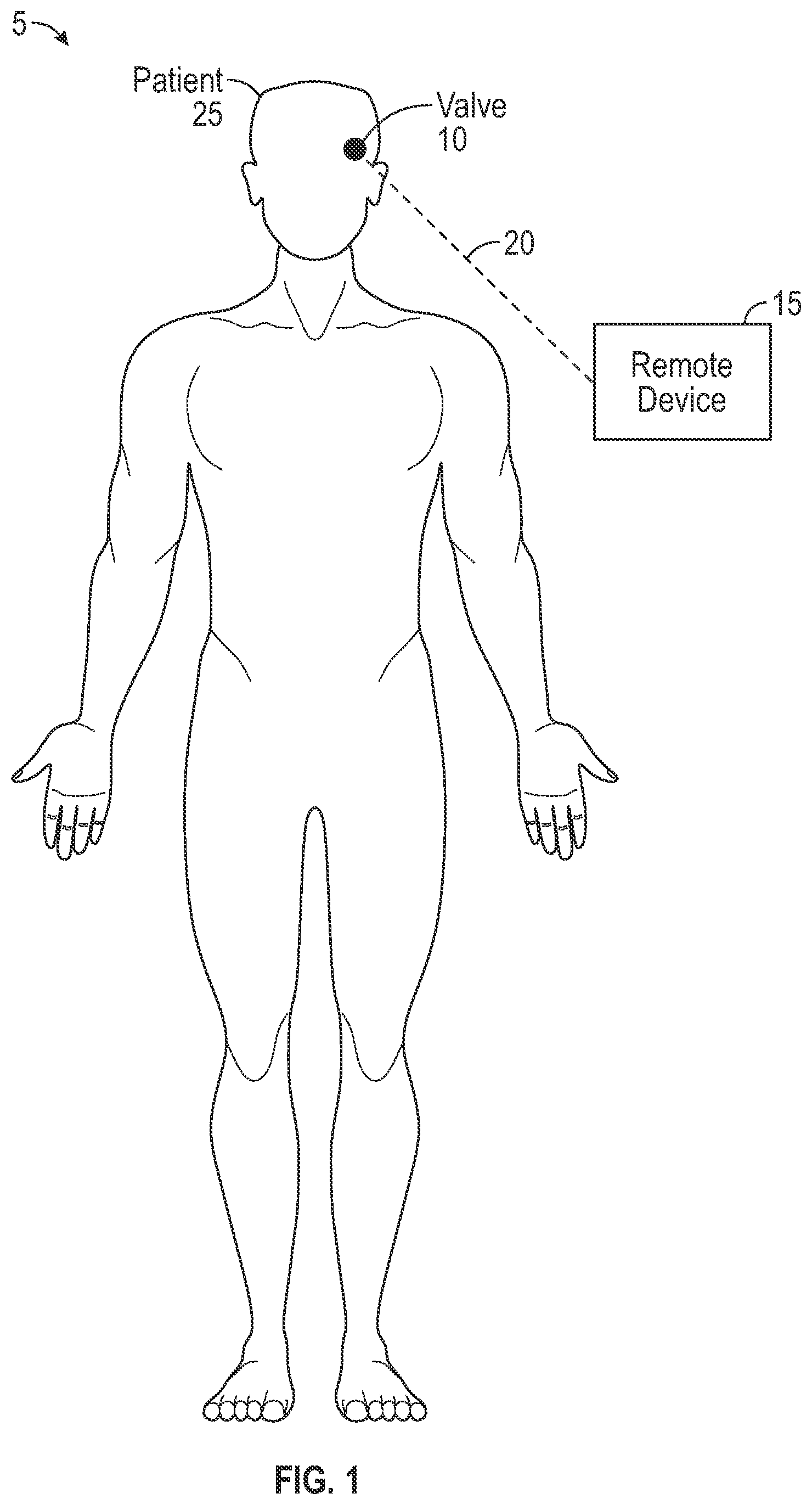 Patent US12551375 — Biofluid shunt valve with sheath and monitoring device — Figure 1