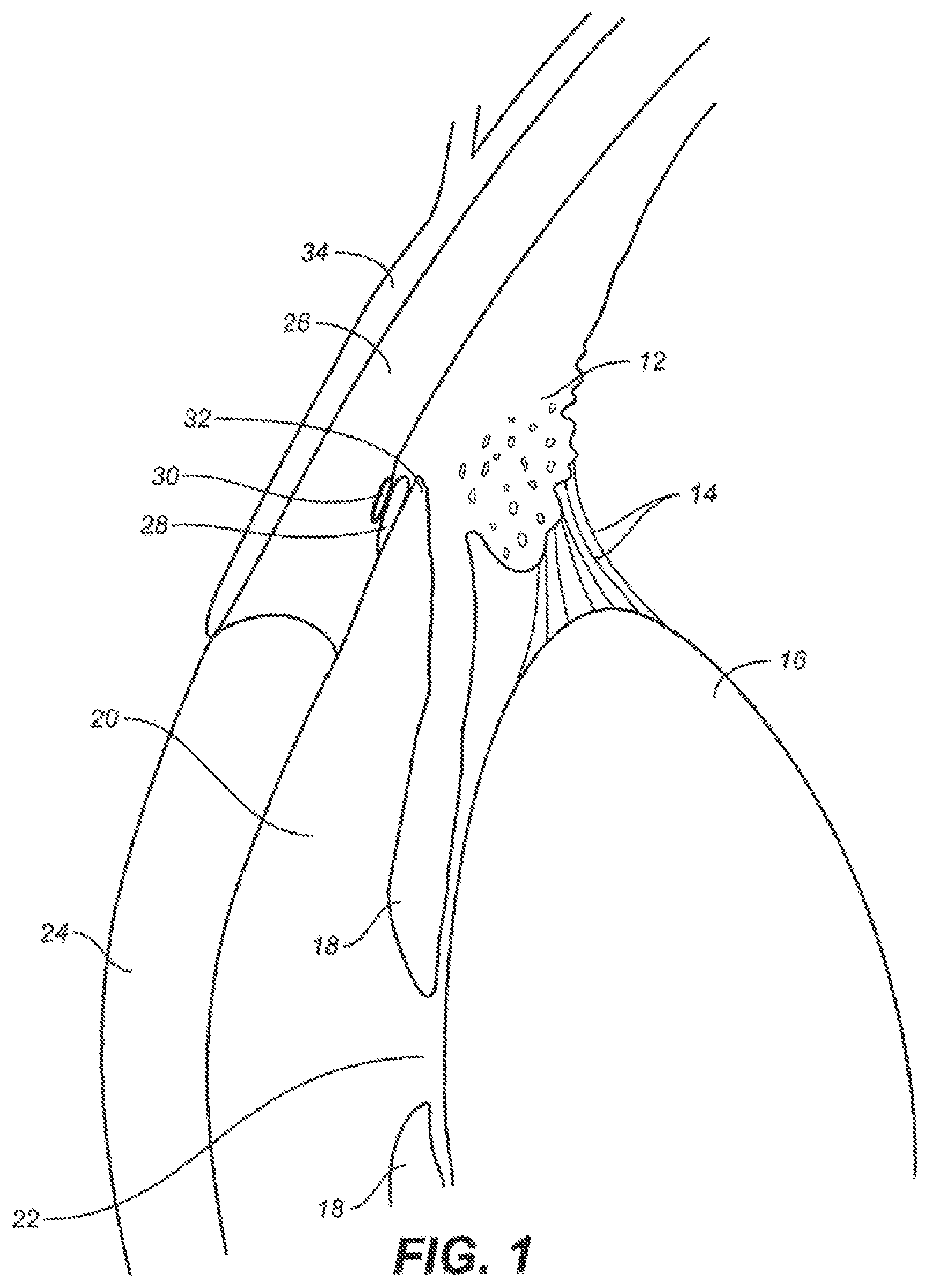 Patent US12551376 — Intraocular implants and methods and kits therefor — Figure 1