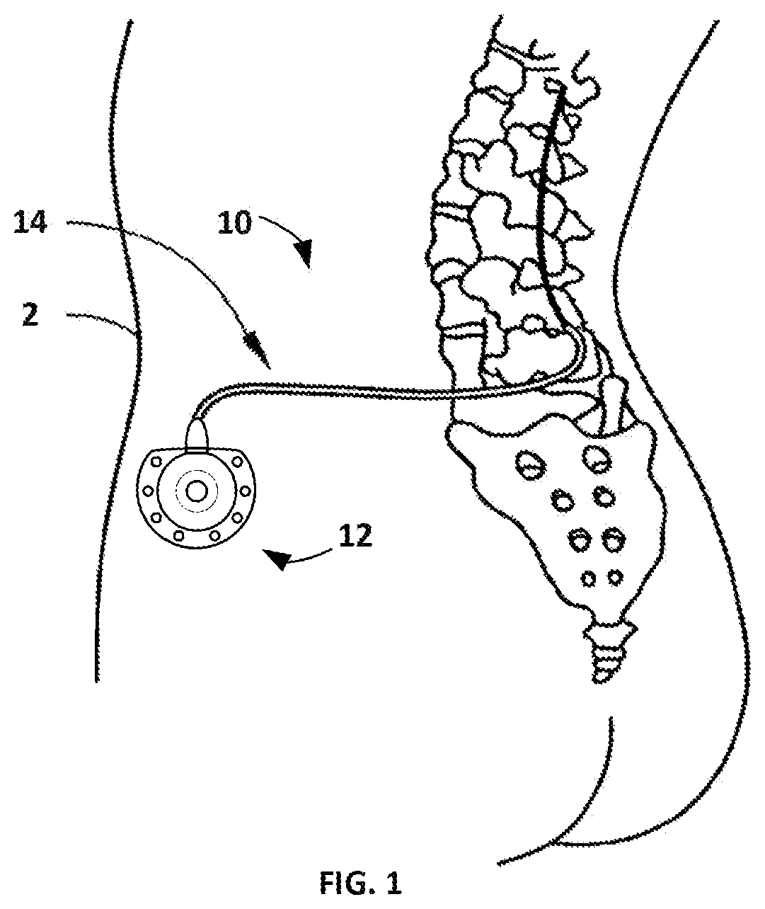 Patent US12551613 — Implantable drug delivery port — Figure 1