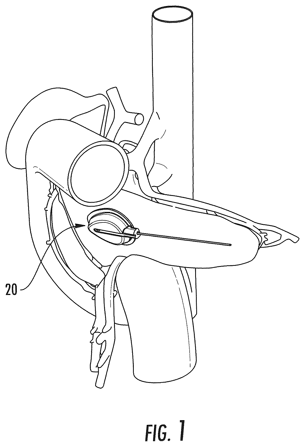Patent US12551691 — Implantable reservoir for use with a medical device and system for interventional drug delivery — Figure 1
