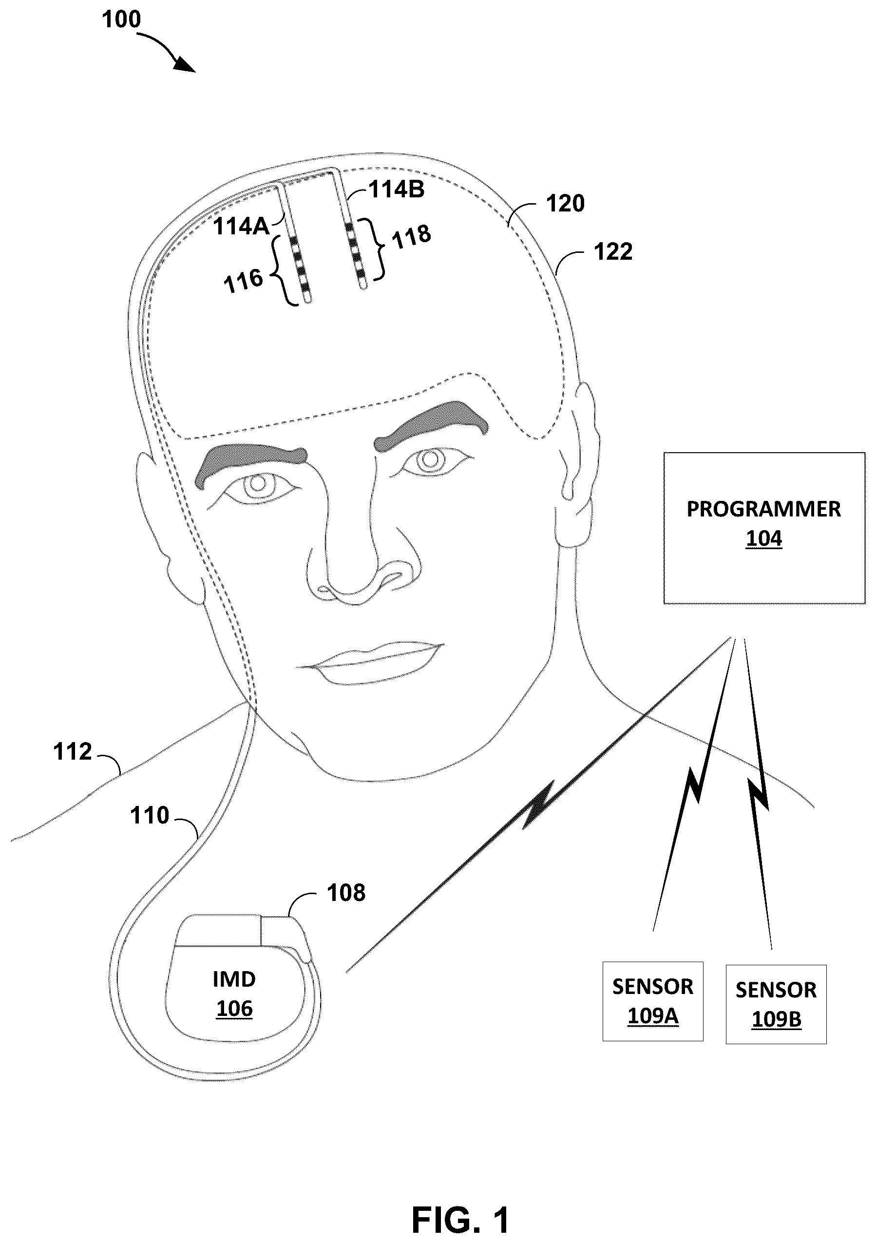 Patent US12551694 Figure 1 – Adaptive deep brain stimulation using homeostatic window