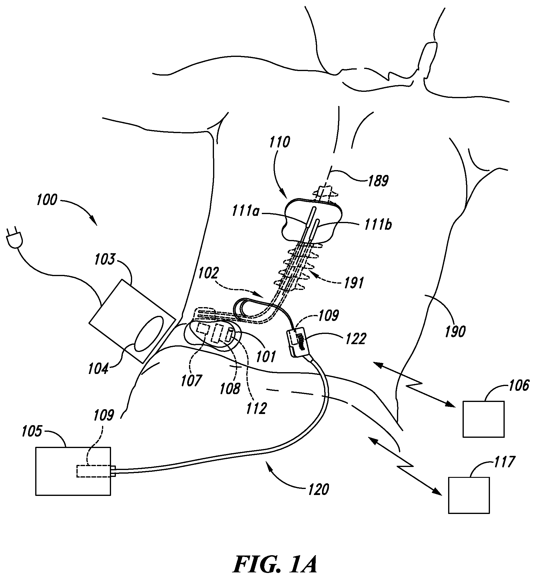 Patent US12551705 Figure 1 – Efficient use of an implantable pulse generator battery, and associated systems and methods