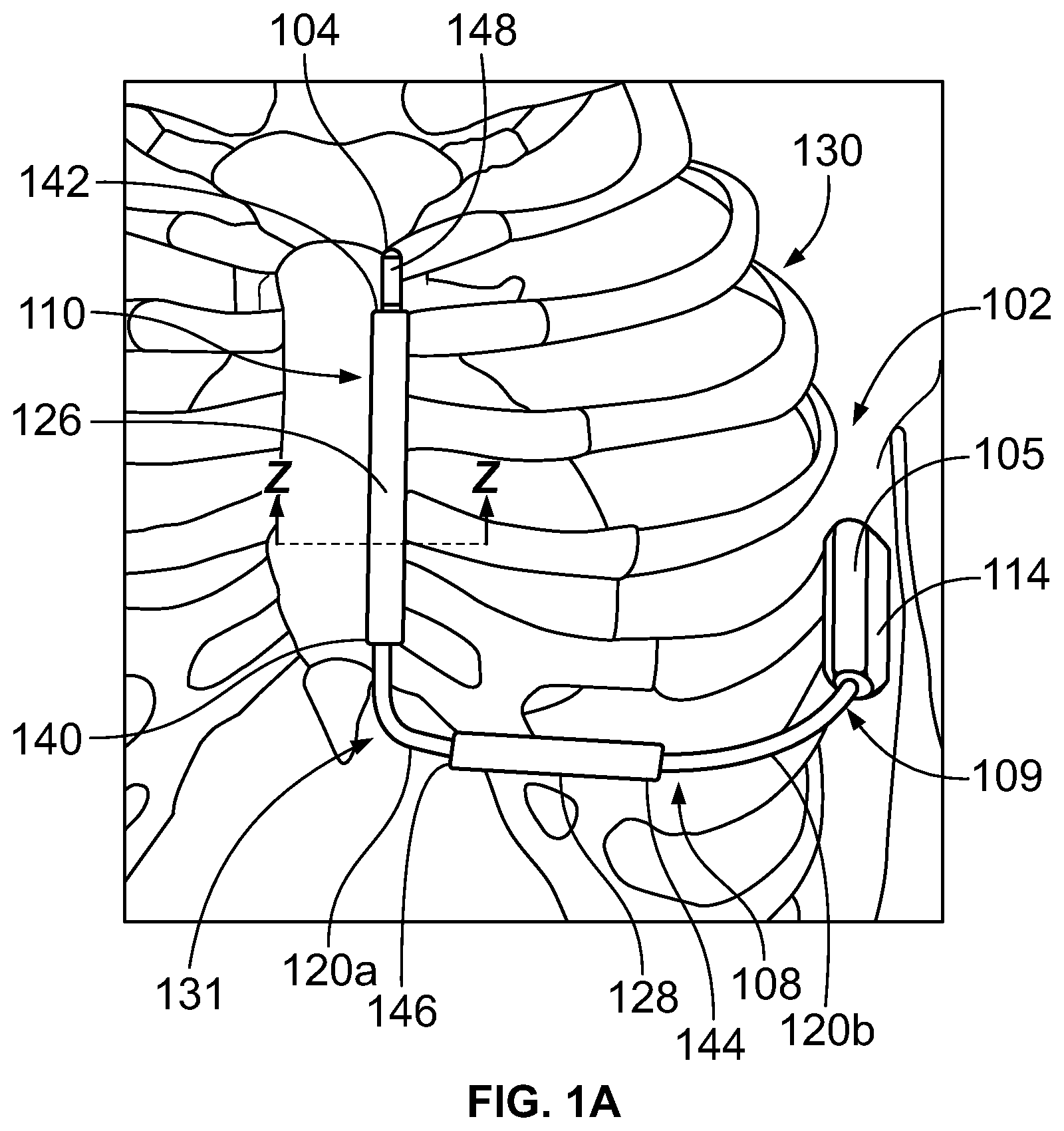 Patent US12551708 — Methods and systems for posture dependent implantable cardioverter defibrillator therapy — Figure 1