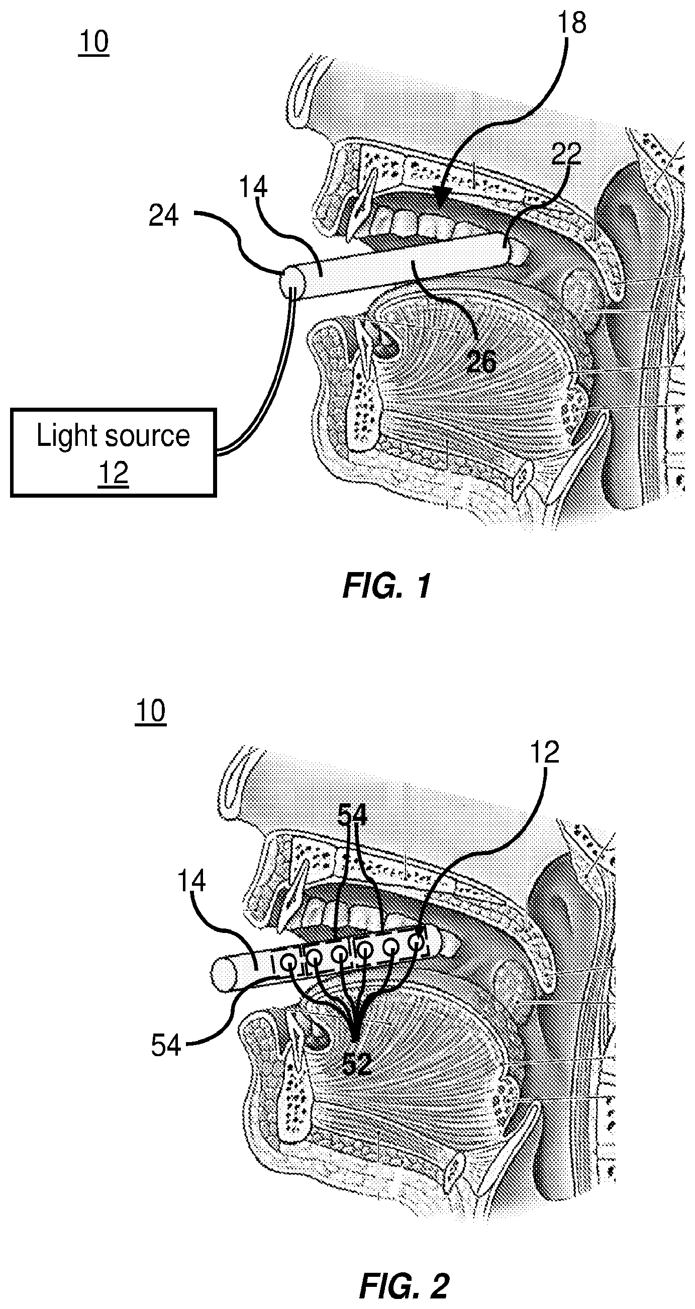 Patent US12551715 — Intraoral phototherapy probe — Figure 1