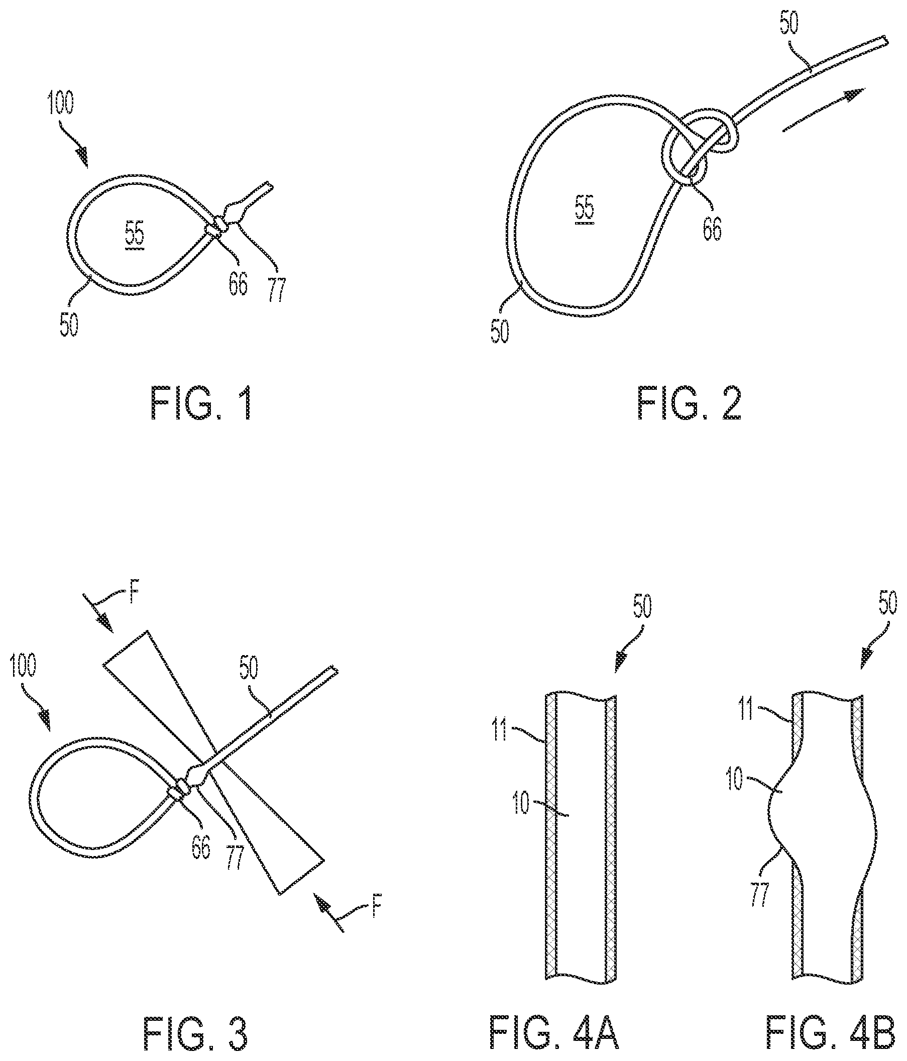 Patent US12564399 Figure 1 – Tensionable knotless surgical techniques