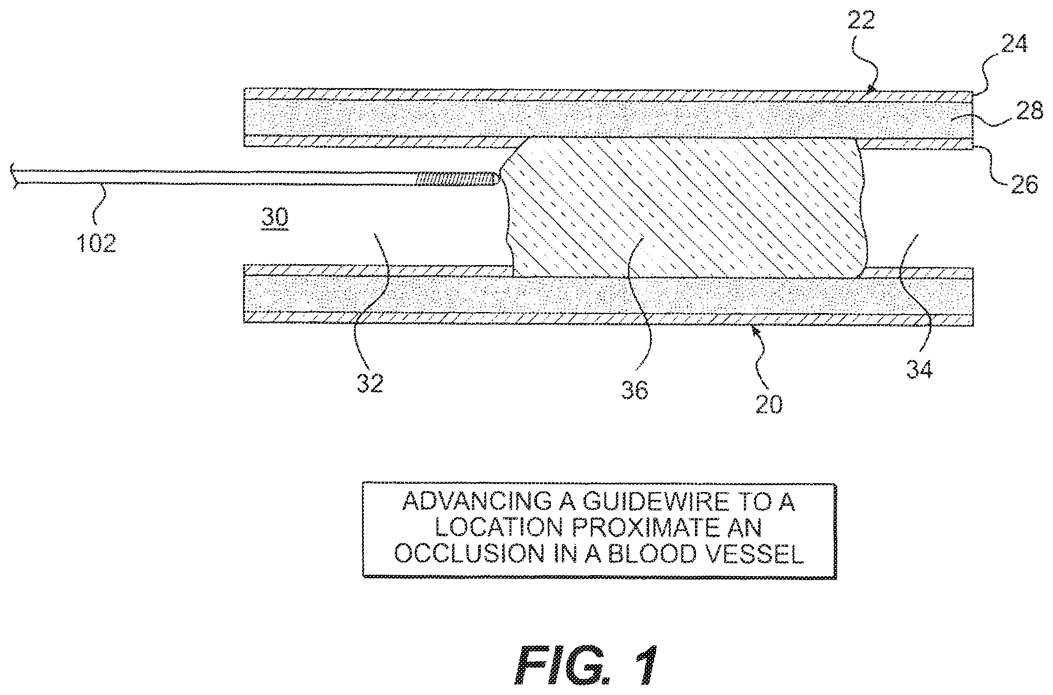 Patent US12564404 — Crossing occlusions in blood vessels — Figure 1