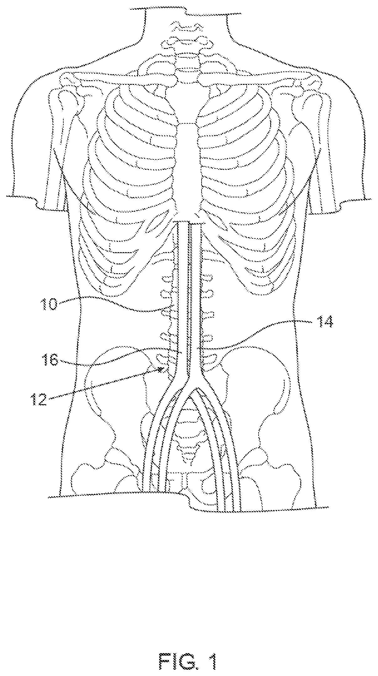 Patent US12564405 — Blood vessel compression systems — Figure 1