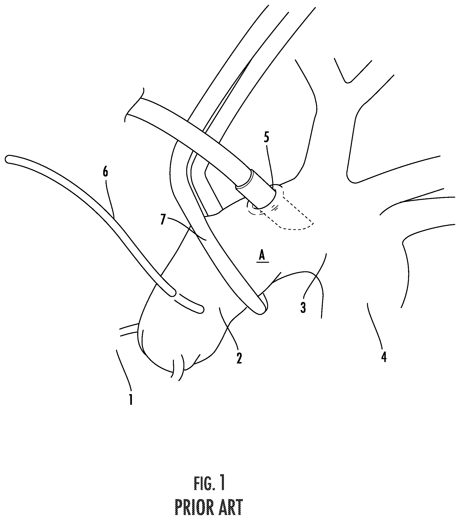 Patent US12564409 — Double lumen aortic cannula and cross clamp assembly and related methods — Figure 1