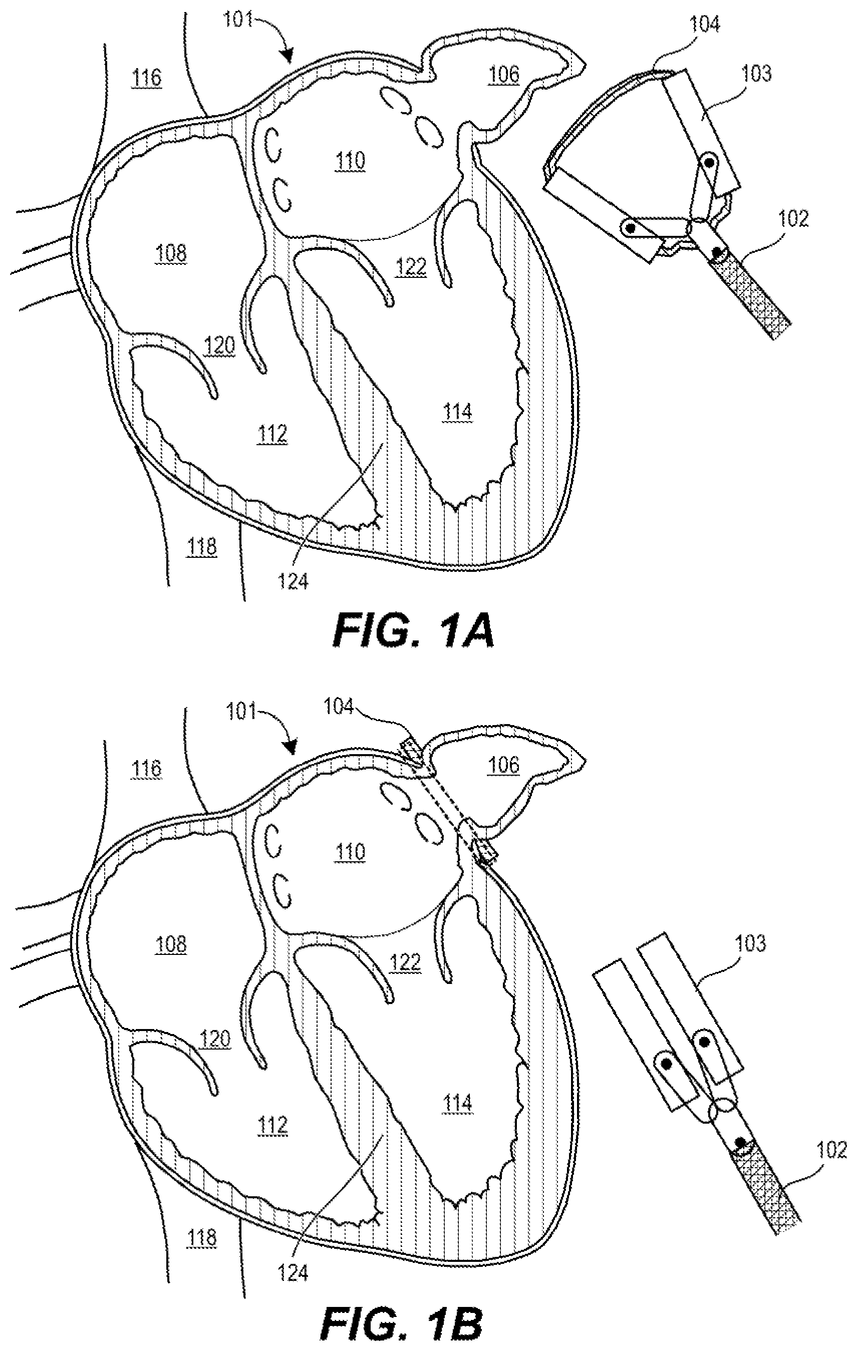Patent US12564411 Figure 1 – Friction compensating, even pressure clip