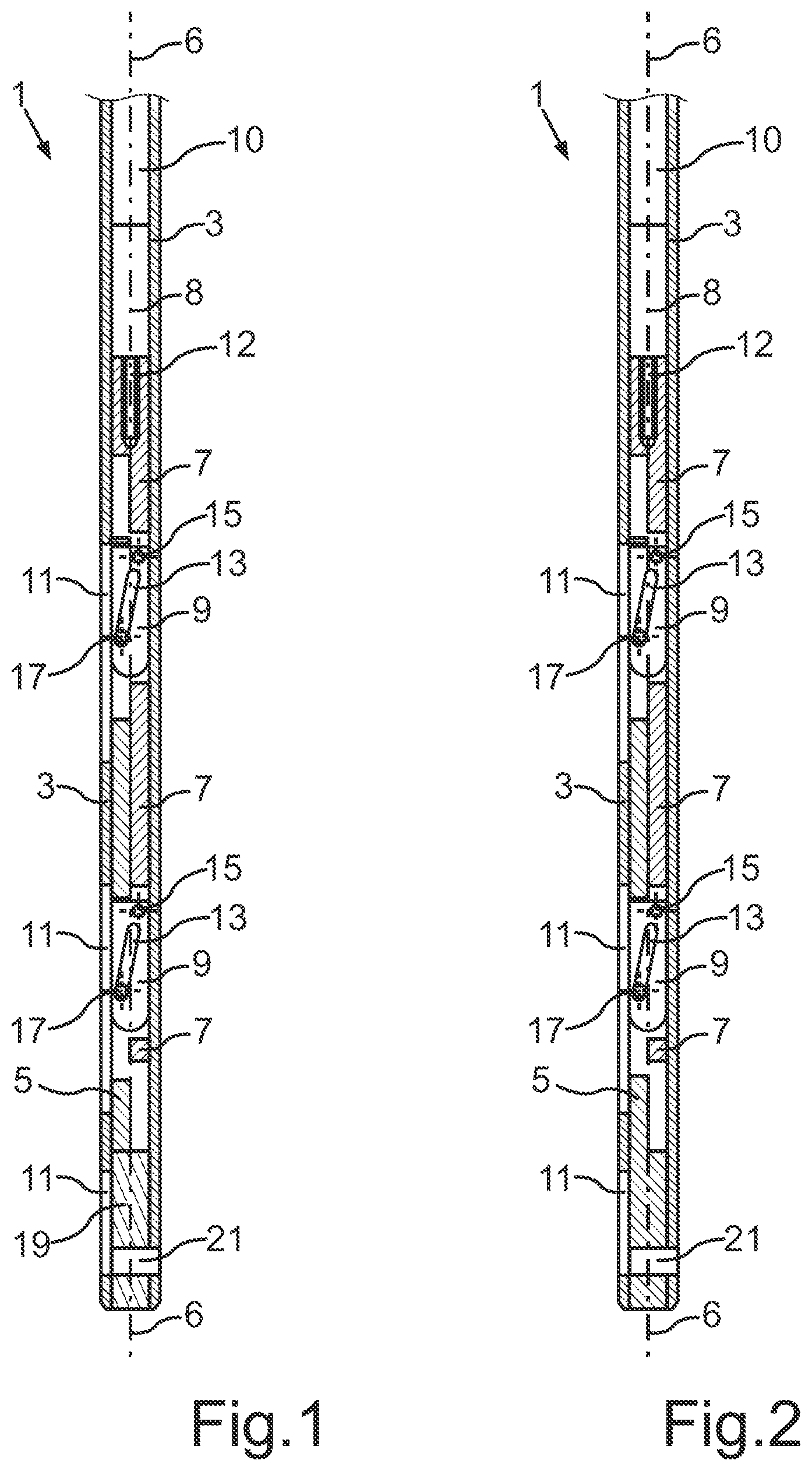 Patent US12564428 — Intramedullary nail for transverse distraction — Figure 1