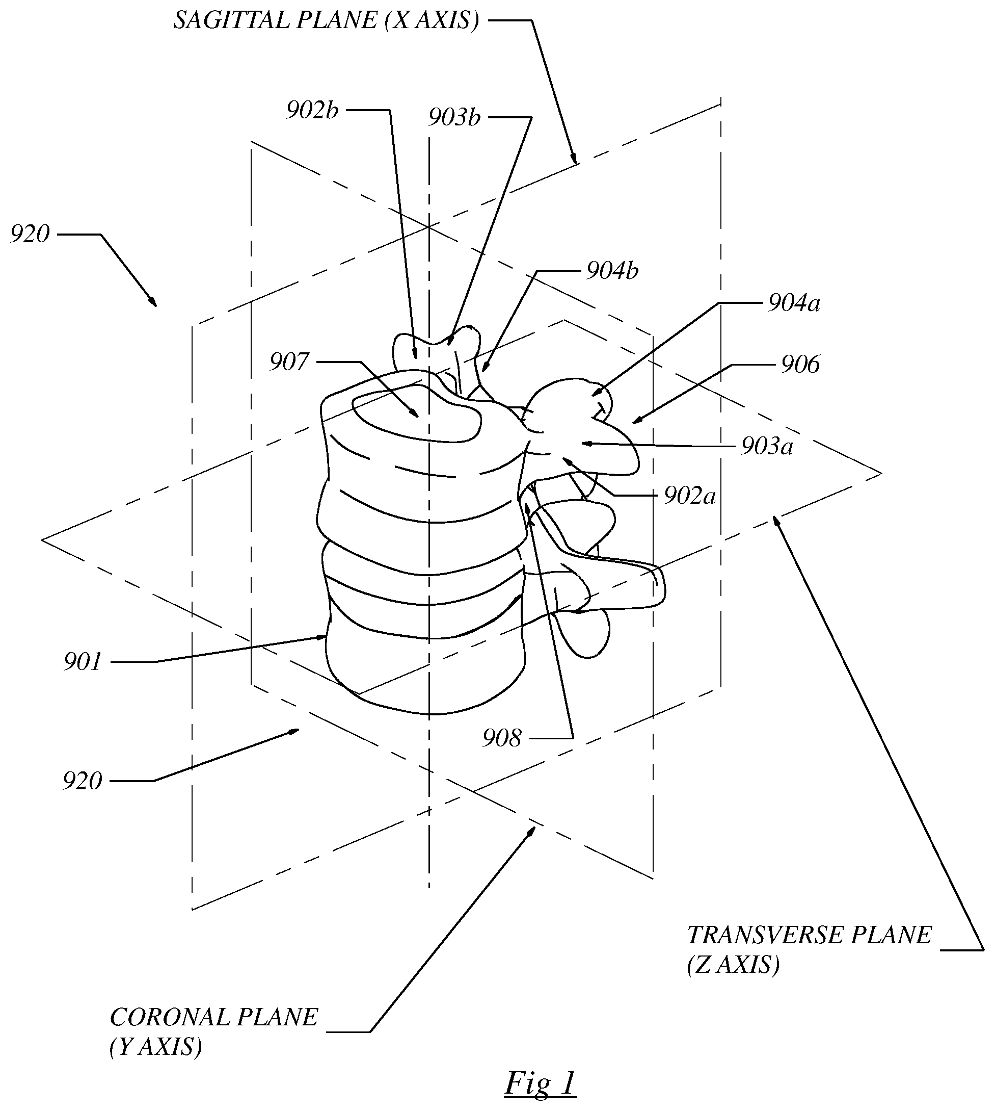 Patent US12564430 — Computerized process for making a patient-specific implant — Figure 1