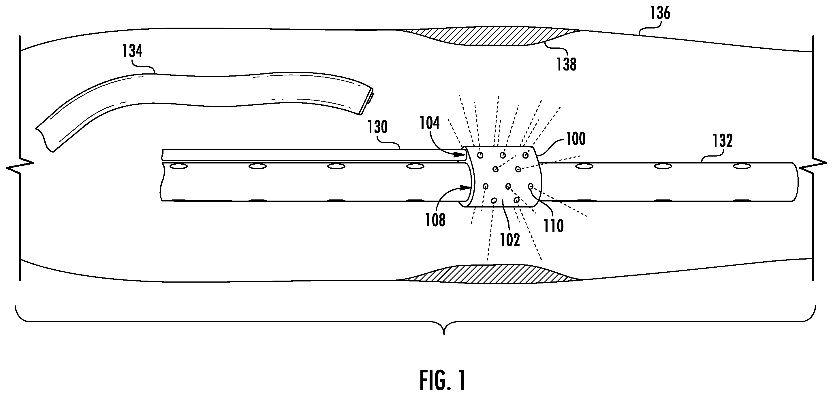 Patent US12564434 — Devices and methods for fluid distribution from a catheter — Figure 1