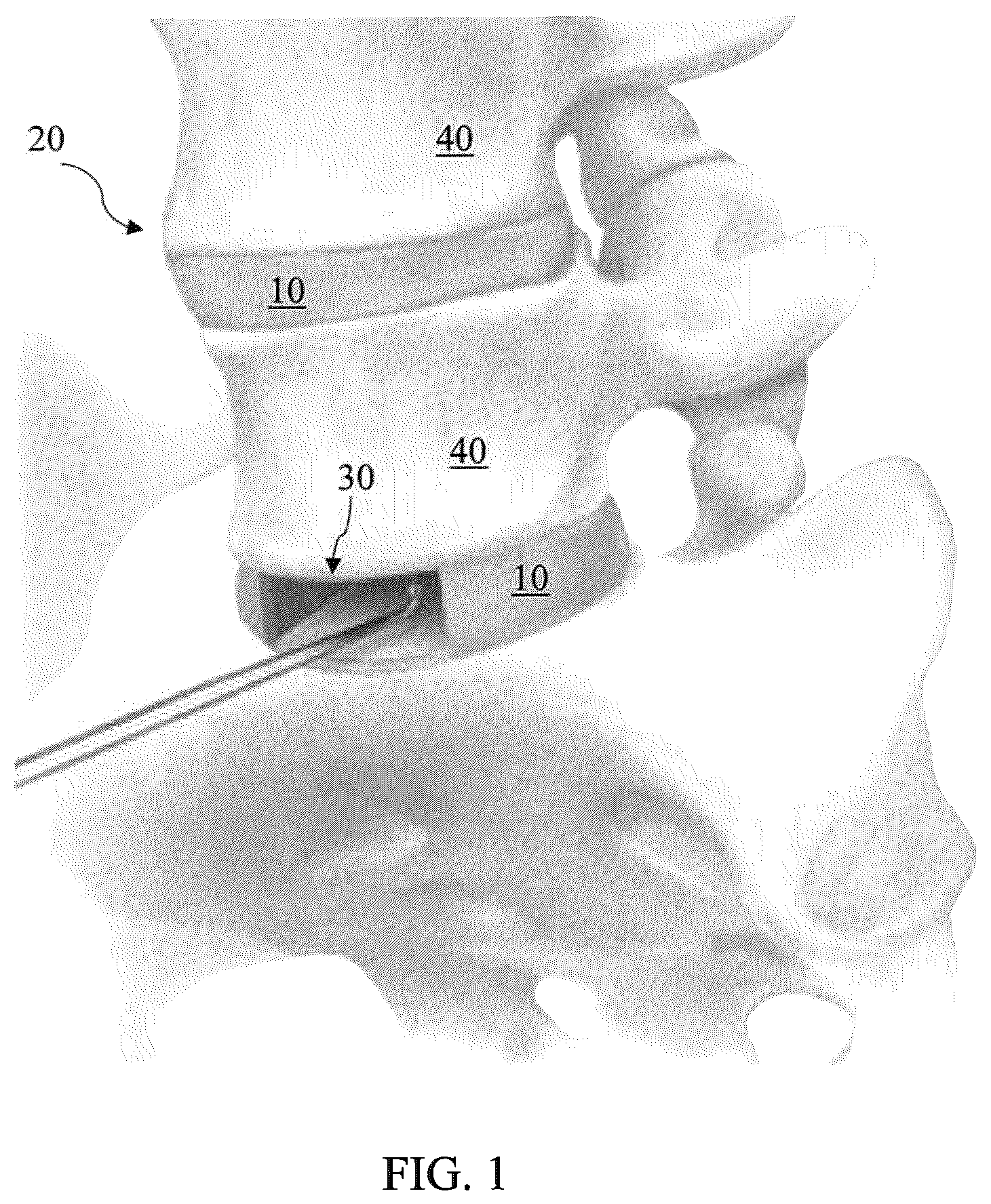 Patent US12564468 — Implant load feedback apparatus — Figure 1