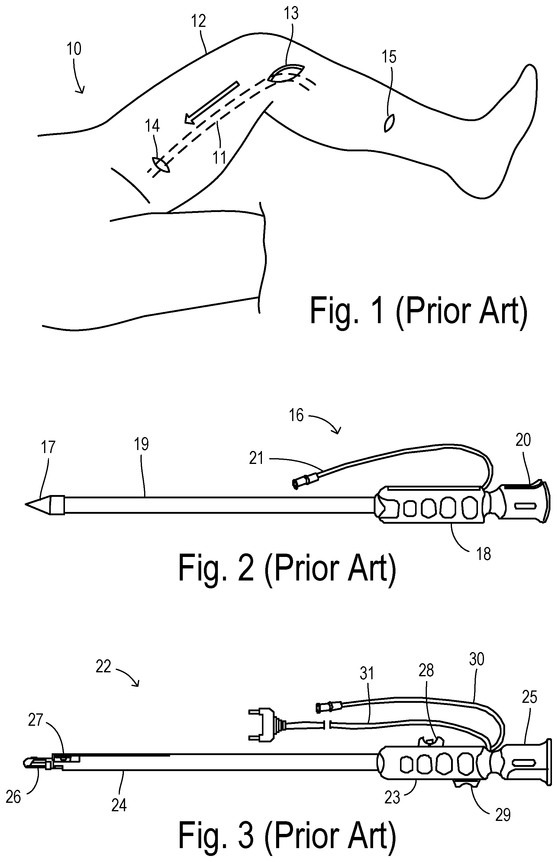 Patent US12564471 — Augmented-reality endoscopic vessel harvesting — Figure 1