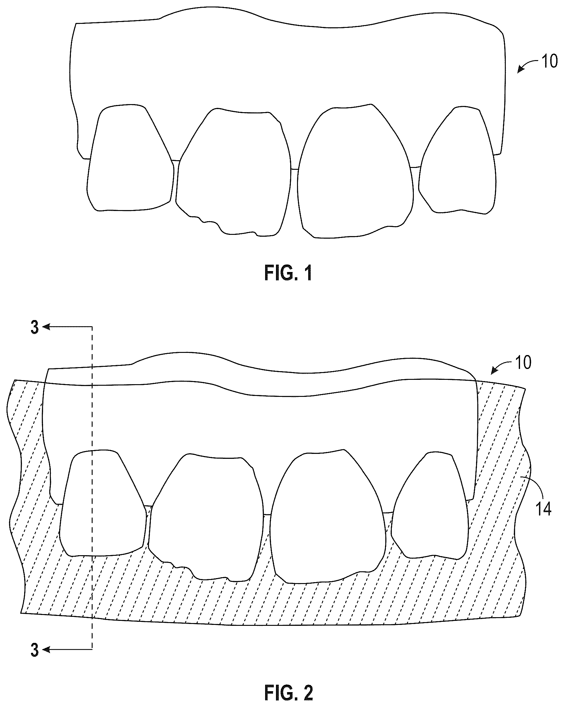 Patent US12564476 — Device and kit for injection bonding multi-tooth dental restoration in a single treatment — Figure 1