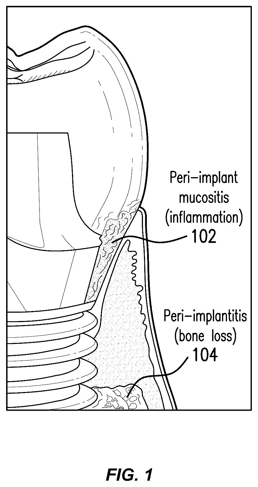 Patent US12564480 Figure 1 – Smart dental implant system for ambulatory dental care