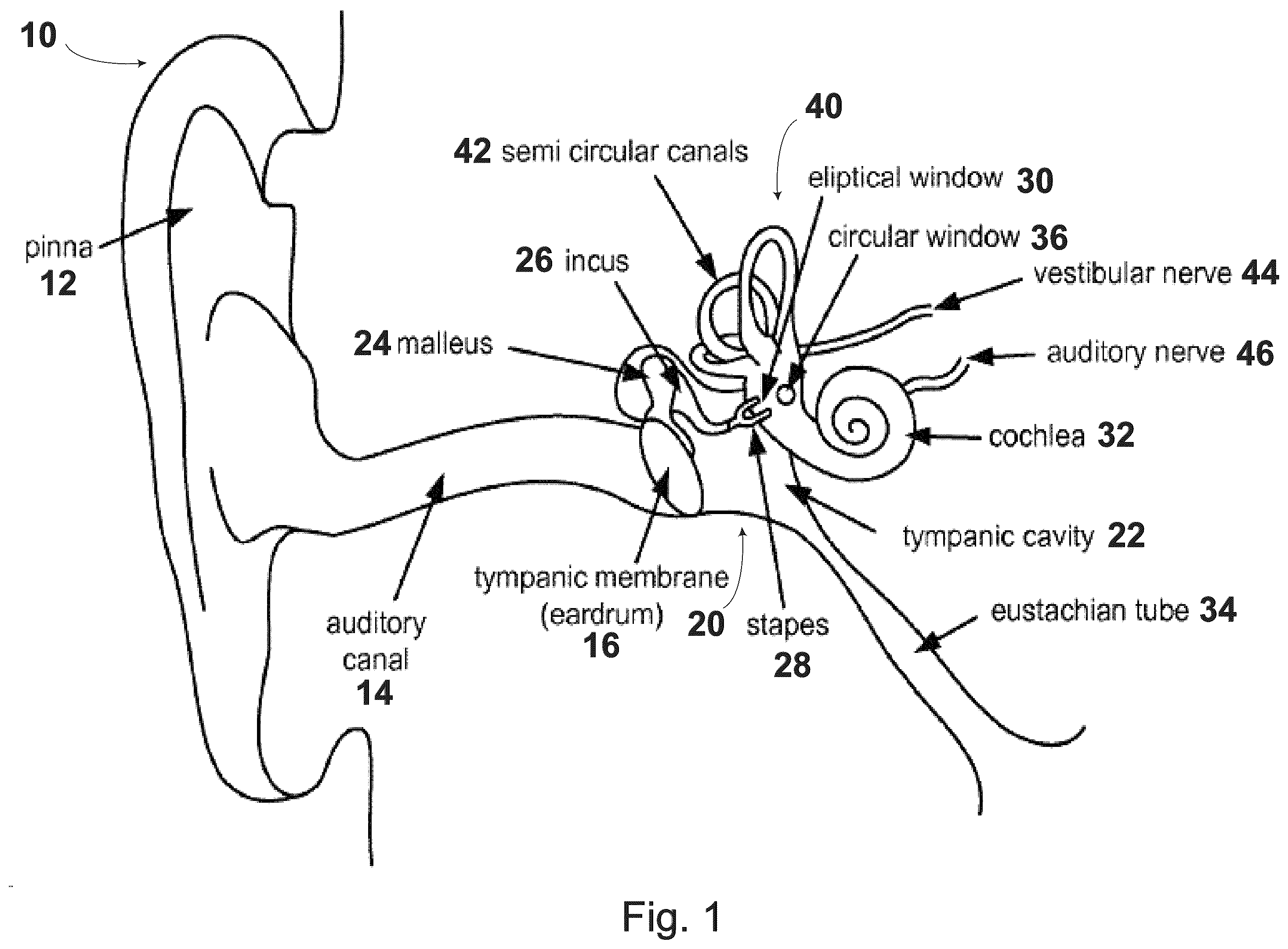 Patent US12564488 — Ossicular replacement prothesis with controllable stapedial conforming function, manufacture method thereof and applicator device therefor — Figure 1