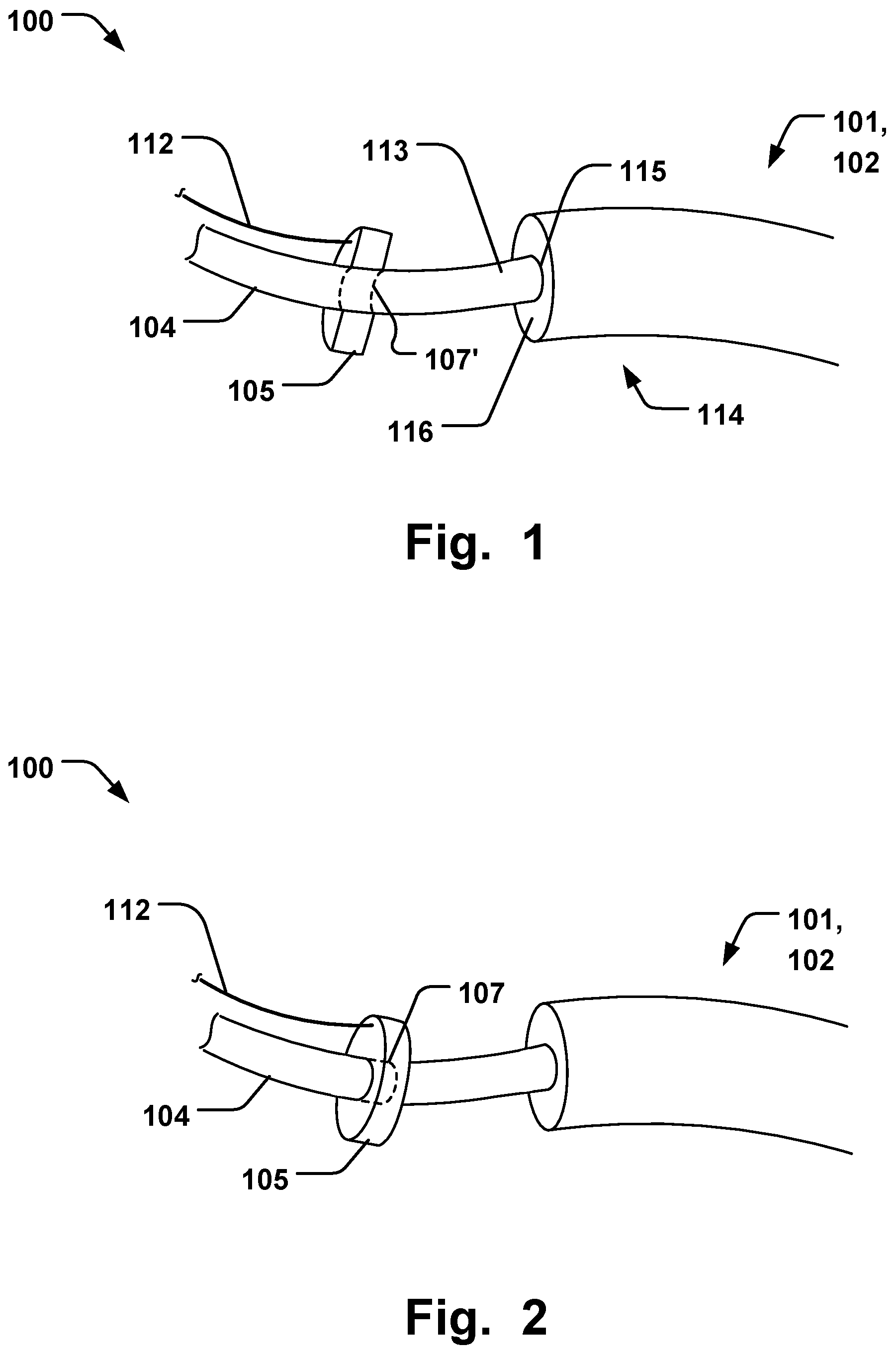 Patent US12564493 Figure 1 – Annuloplasty system