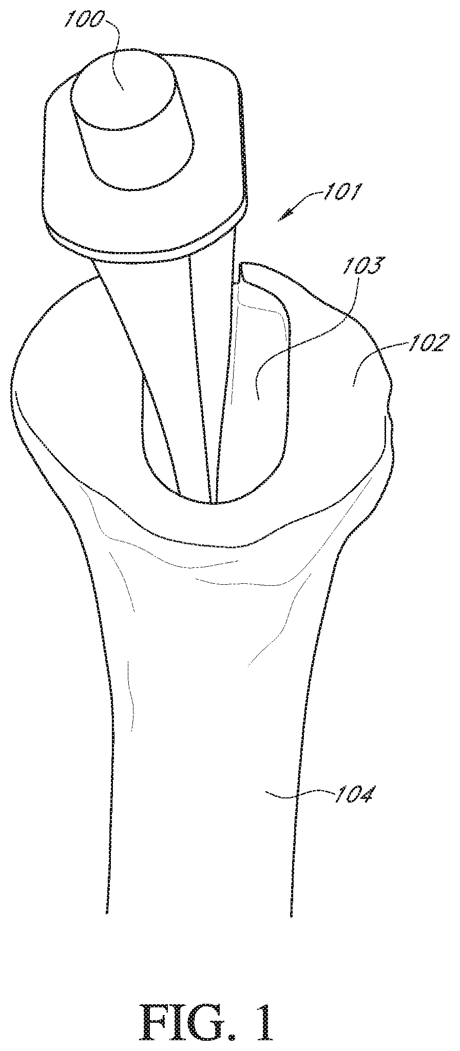 Patent US12564498 — Alignment guide for humeral or femoral stem replacement prostheses — Figure 1