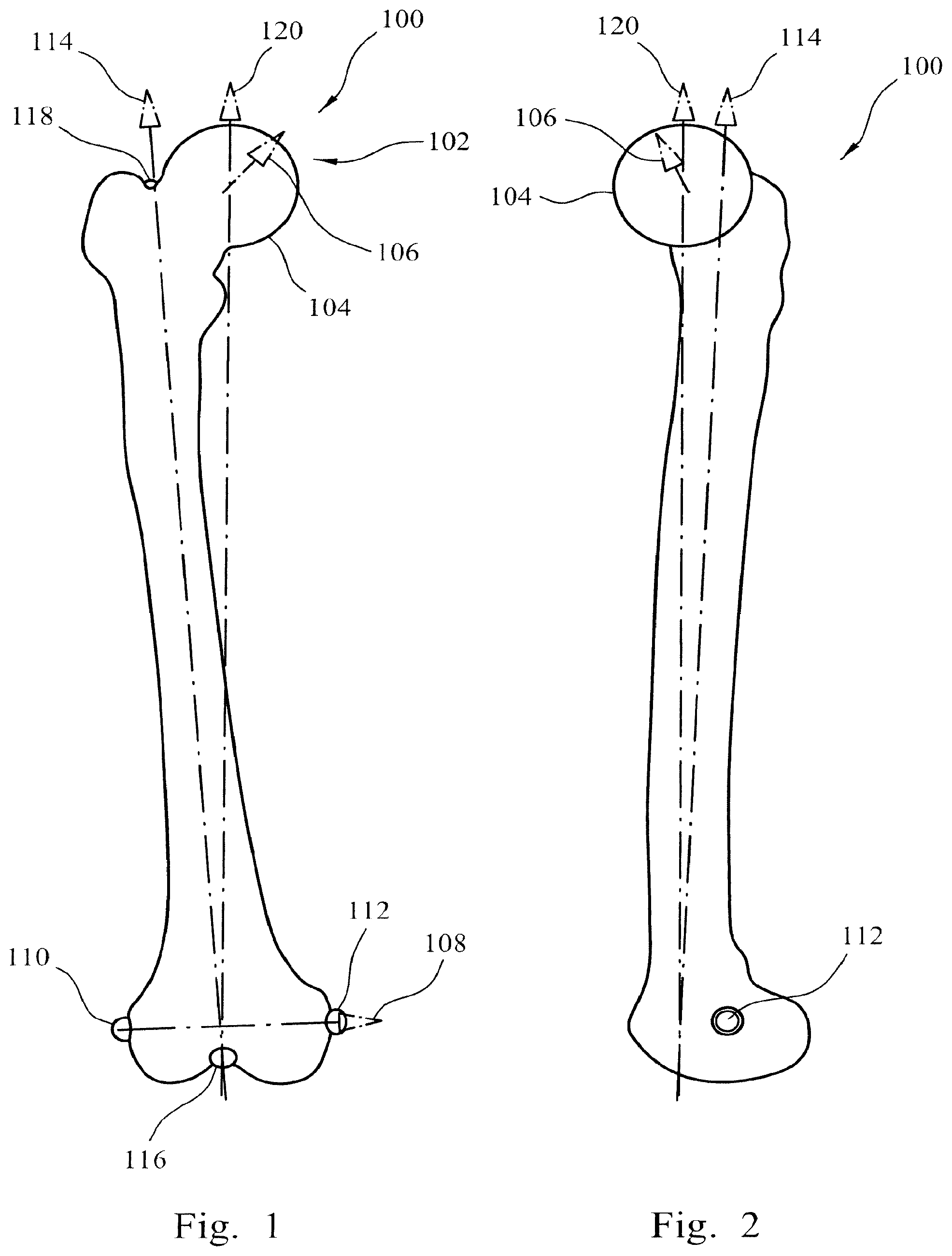 Patent US12564500 — Femoral trialling kit and assembly — Figure 1