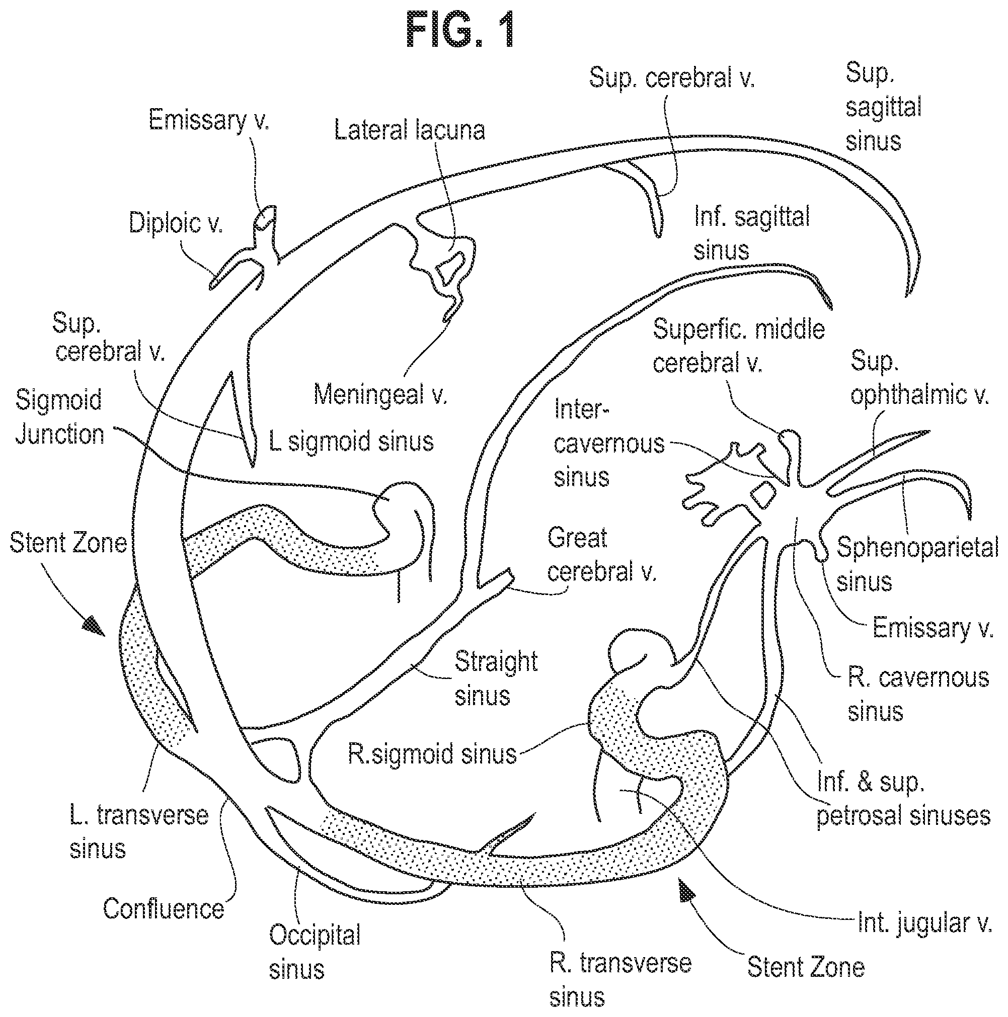 Patent US12564504 — Method and system for delivering a self-expanding stent to the venous sinuses — Figure 1