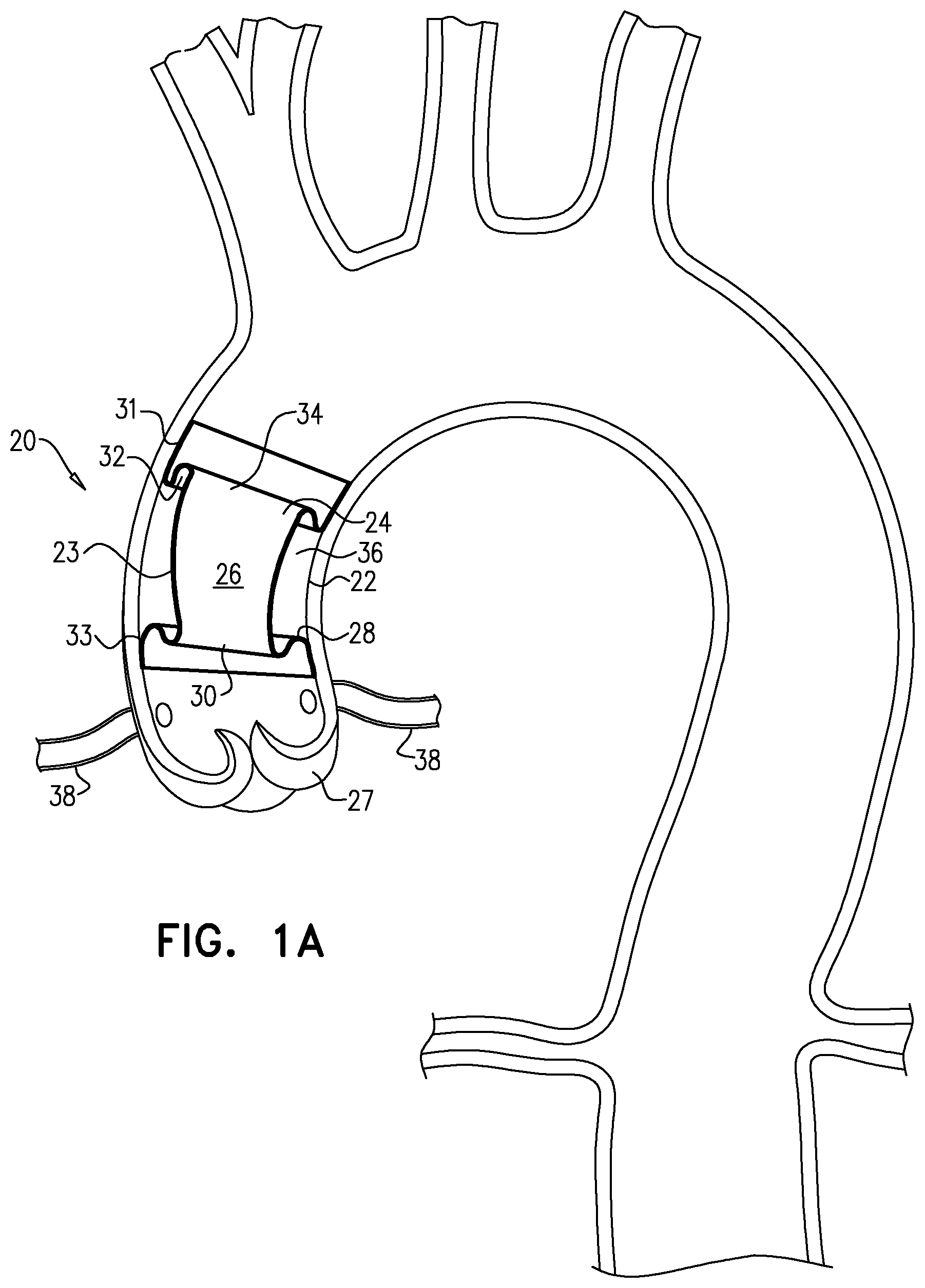 Patent US12564505 — Aortic pressure loss reduction apparatus and methods — Figure 1