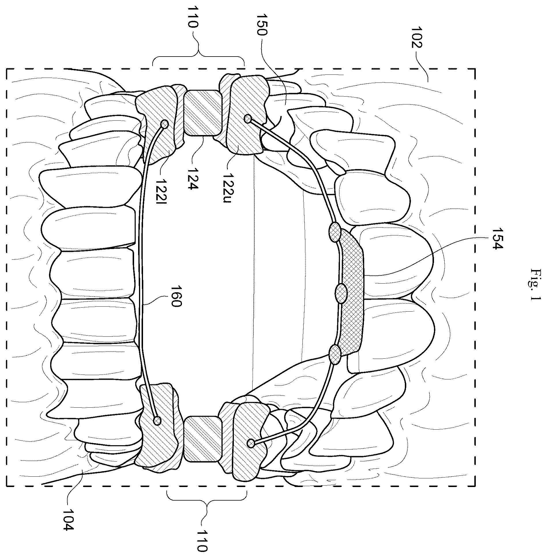 Patent US12564512 — Configurable breathing assist mouthpiece device — Figure 1