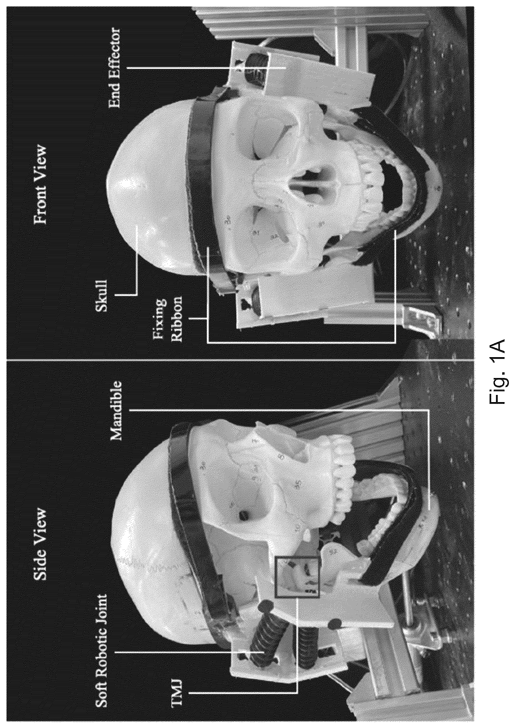 Patent US12564531 Figure 1 – Soft exoskeleton wearable device for temporomandibular disorder (TMD) rehabilitation