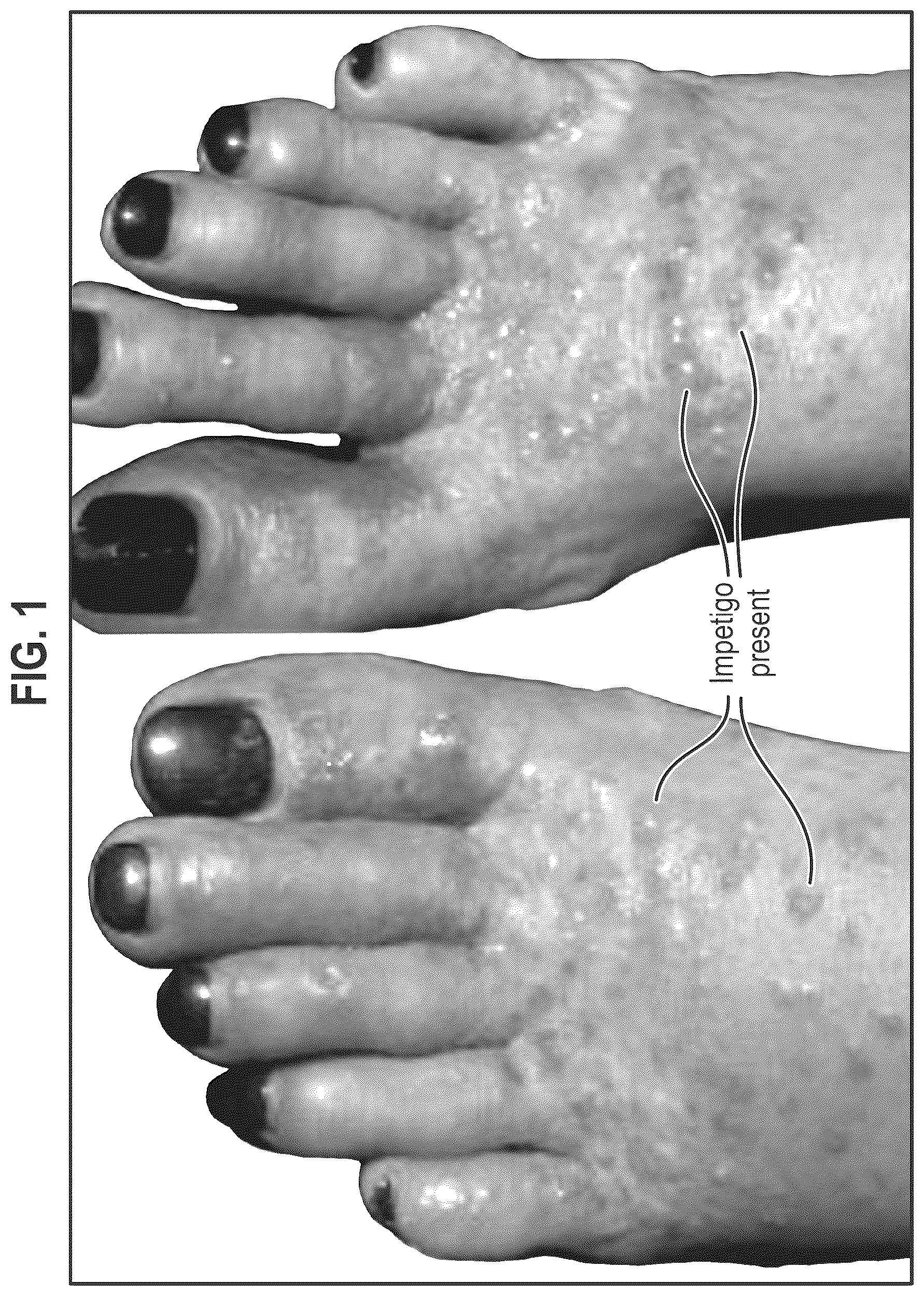Patent US12564563 — Composition and methods for treating pathogenic infections on wounds — Figure 1