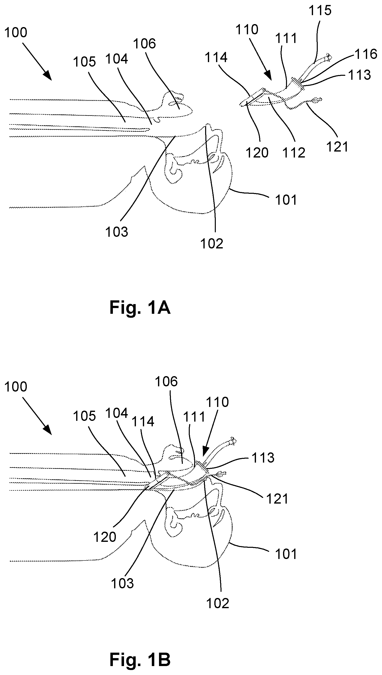 Patent US12564693 Figure 1 – Laryngeal mask airway intubation guide and method