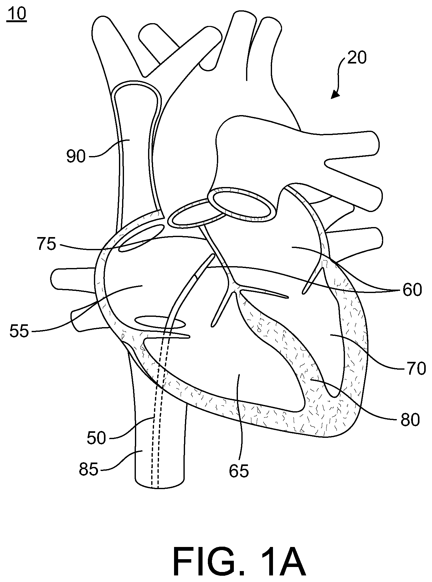 Patent US12564706 — Enhanced dilator and methods of using the same — Figure 1