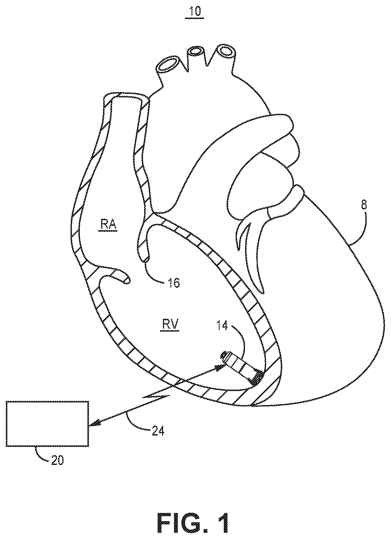 Patent US12564720 Figure 1 – Method and apparatus for atrial event detection