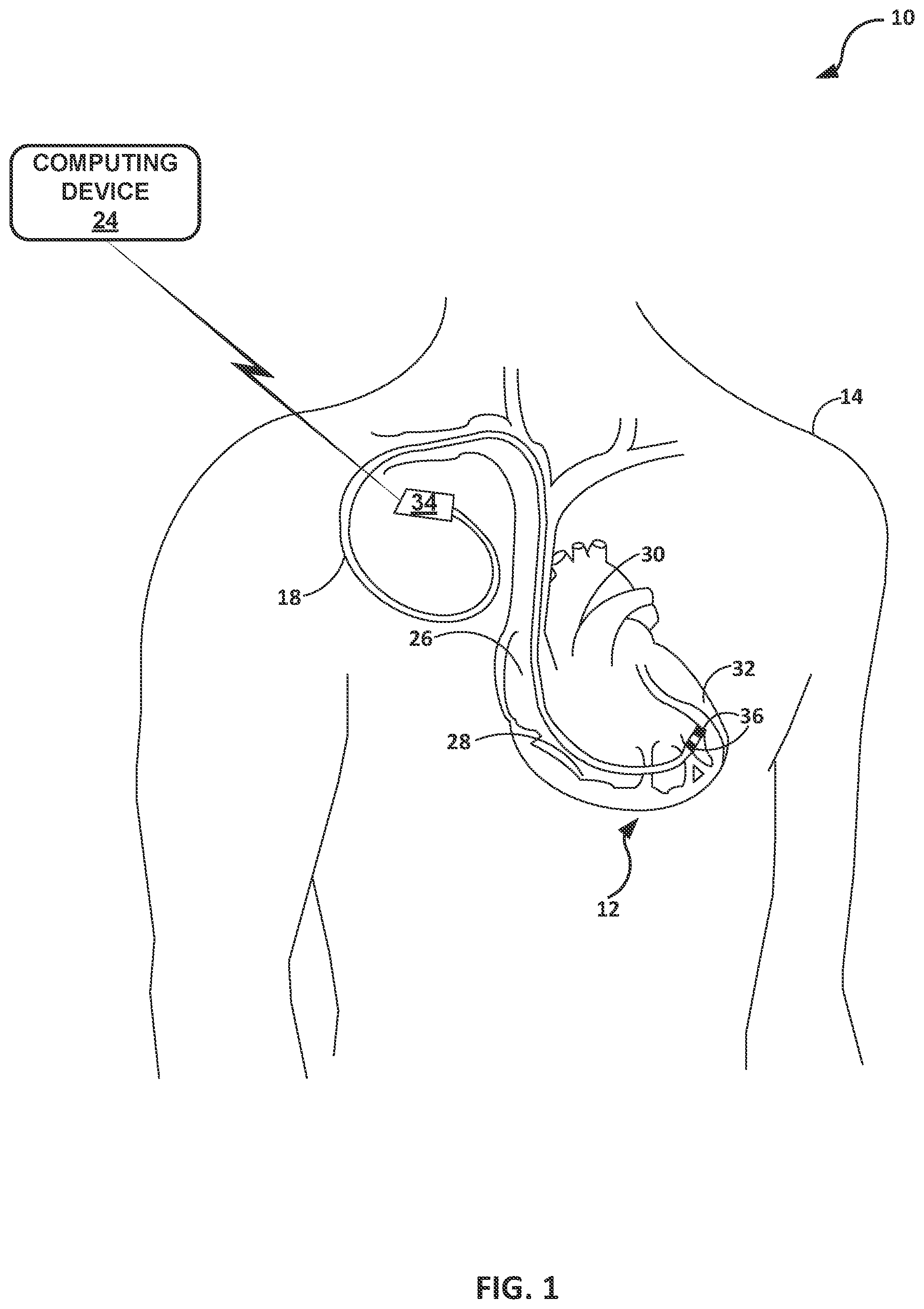 Patent US12564721 — Assessing pacemaker dependency — Figure 1